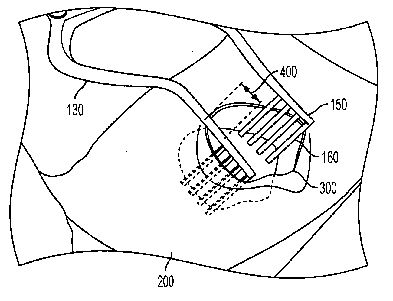 Novel retractor for hernia surgery