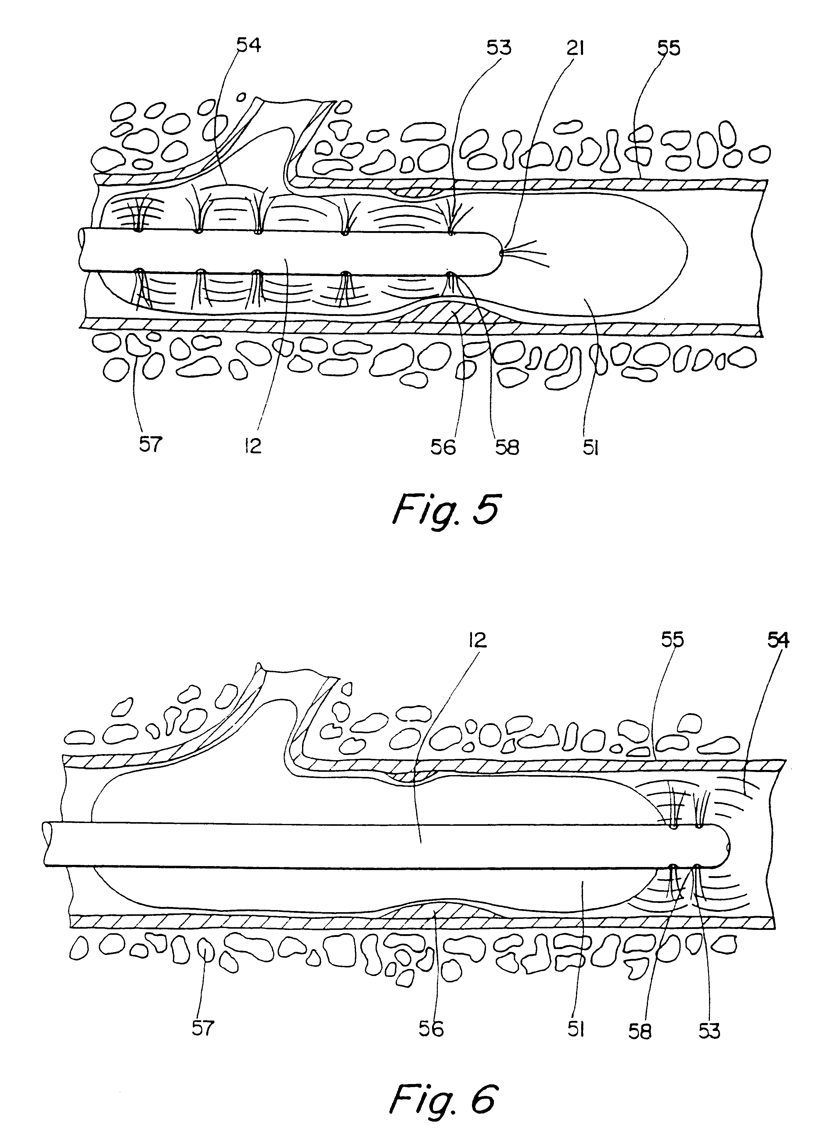 Thrombolysis device