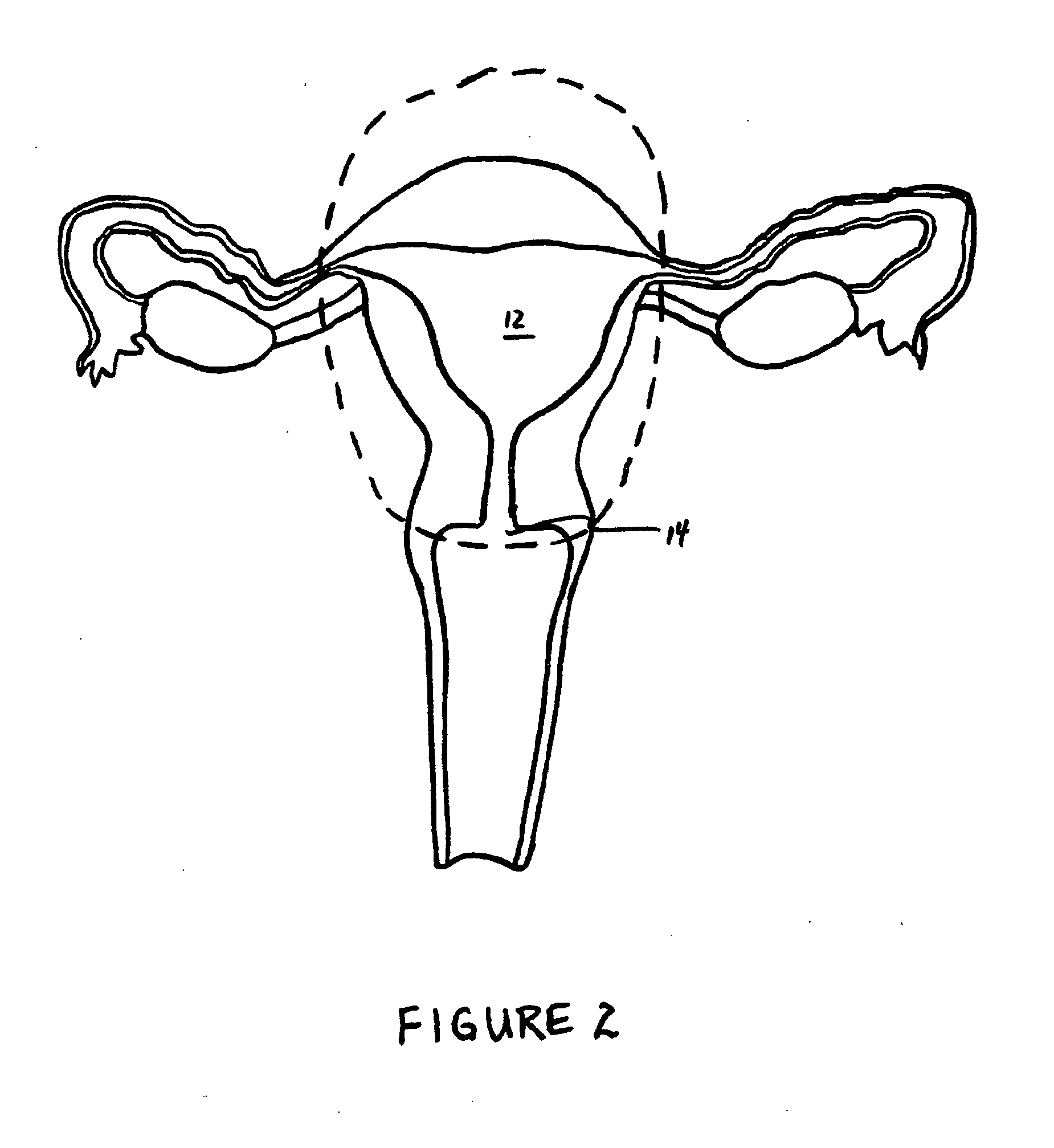 Intrauterine implant and methods of use