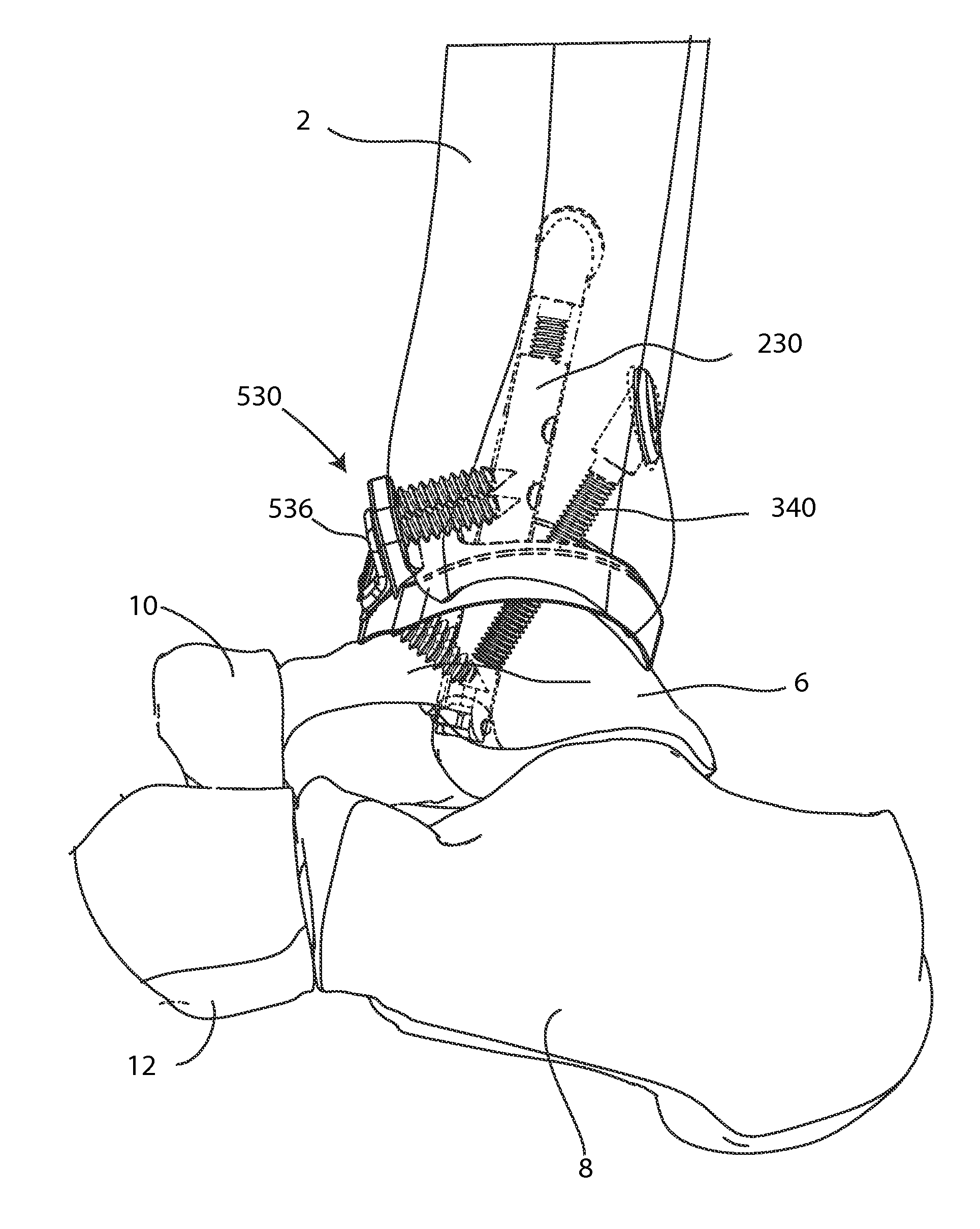 Joint arthrodesis and arthroplasty