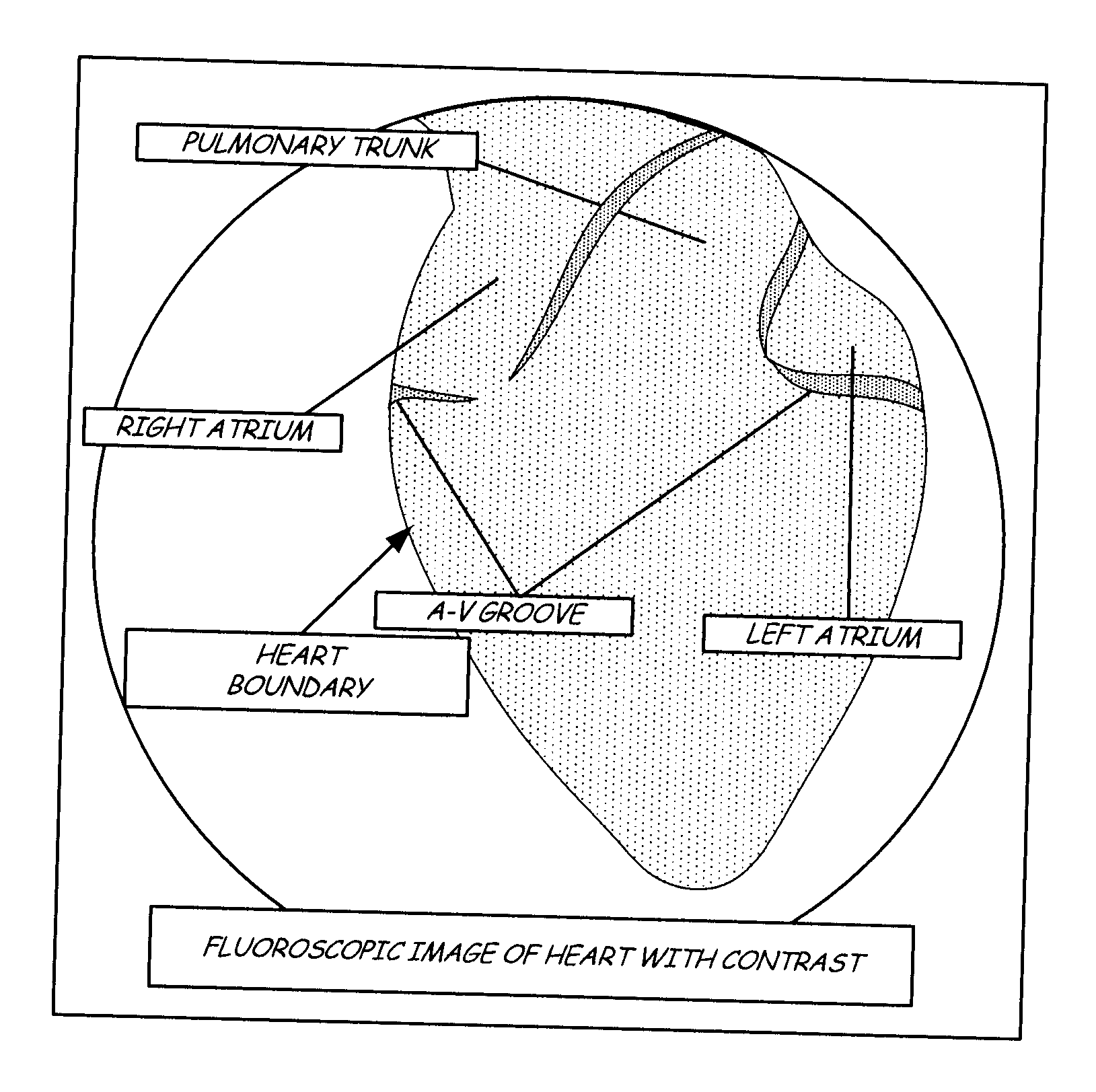 Pericardial space imaging for cardiac support device implantation