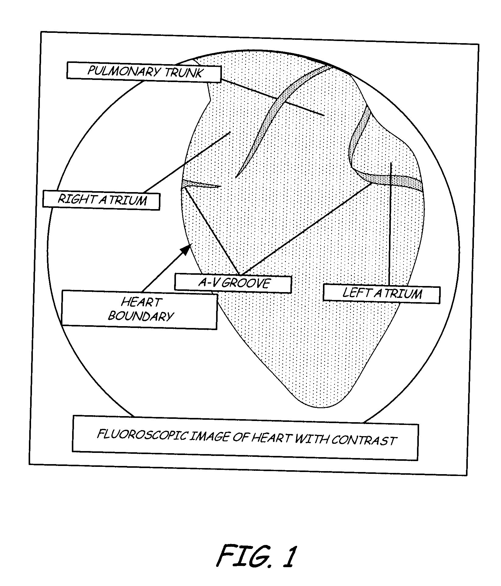 Pericardial space imaging for cardiac support device implantation