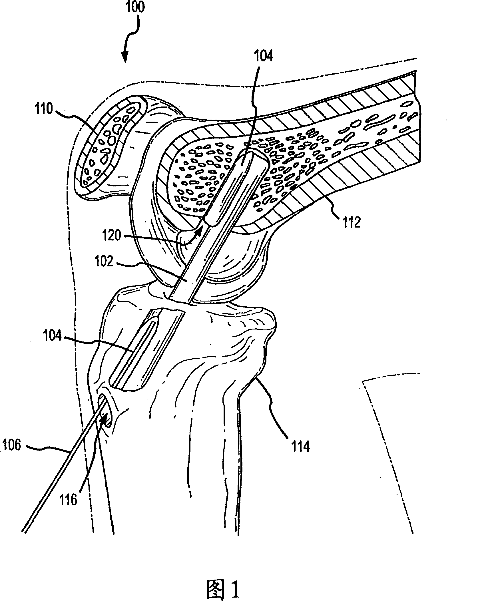 A graft fixation device and method