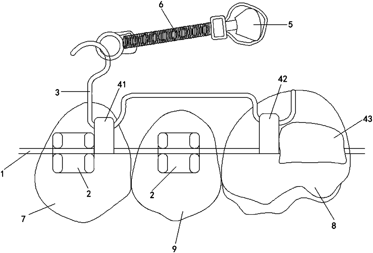 Device for moving molar to far-middle based on micro-implant anchorage