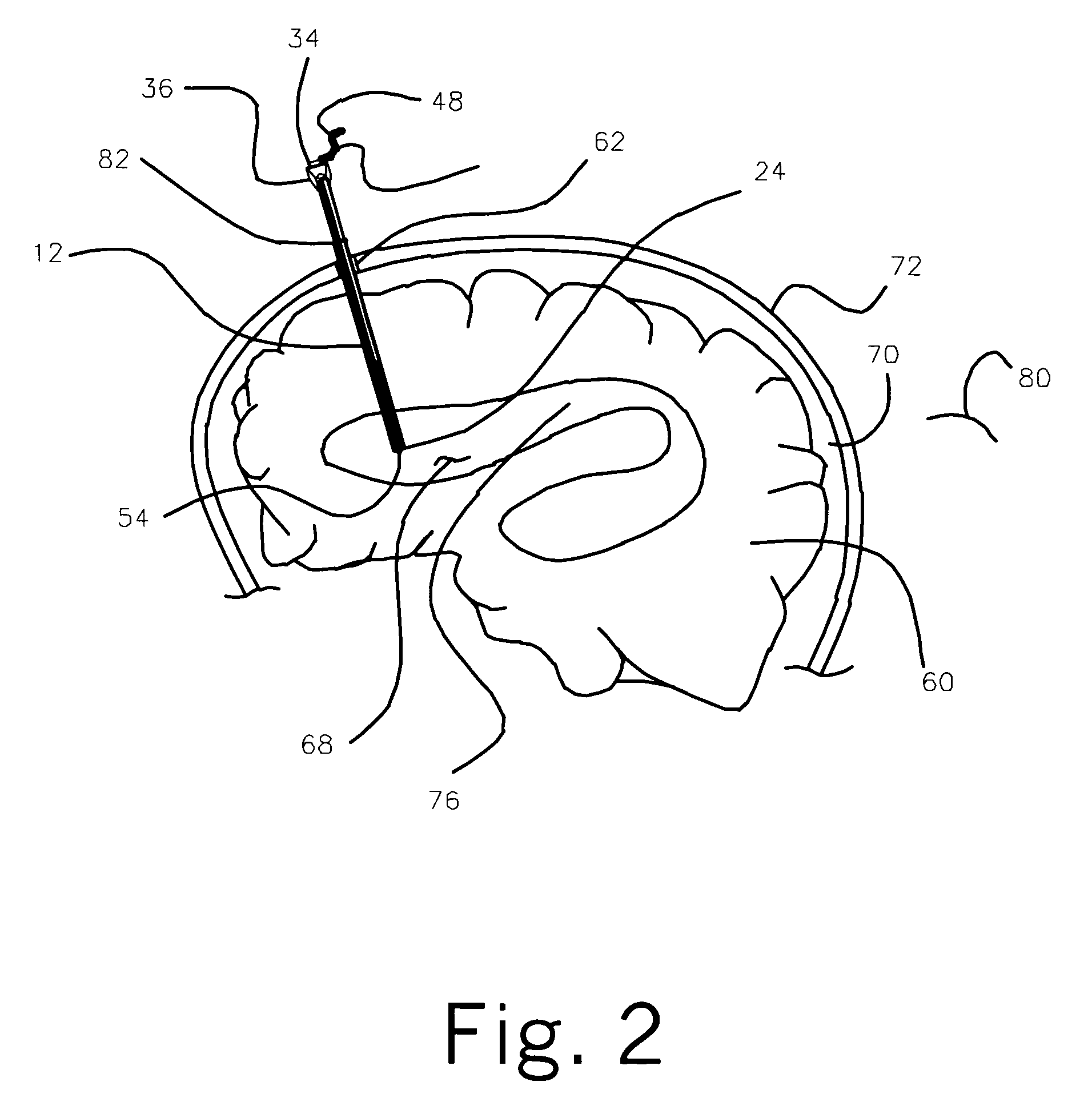 Medical device and method for temperature control and treatment of the brain and spinal cord