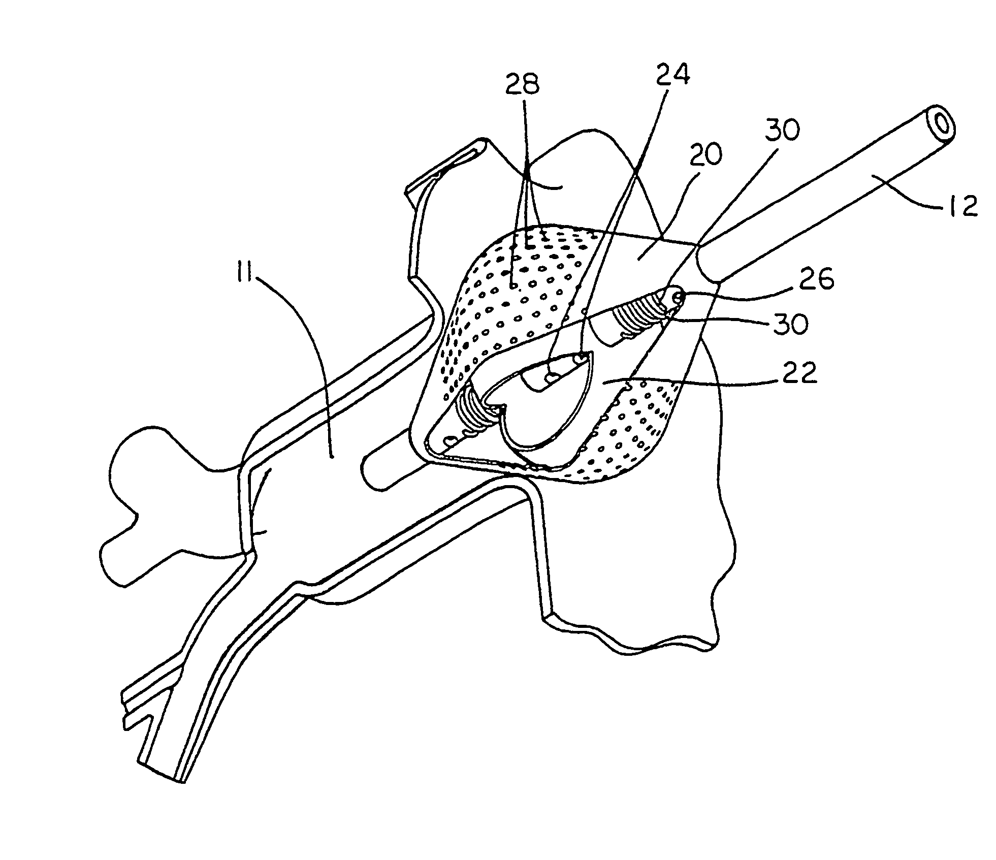 Process and device for the treatment of atrial arrhythmia