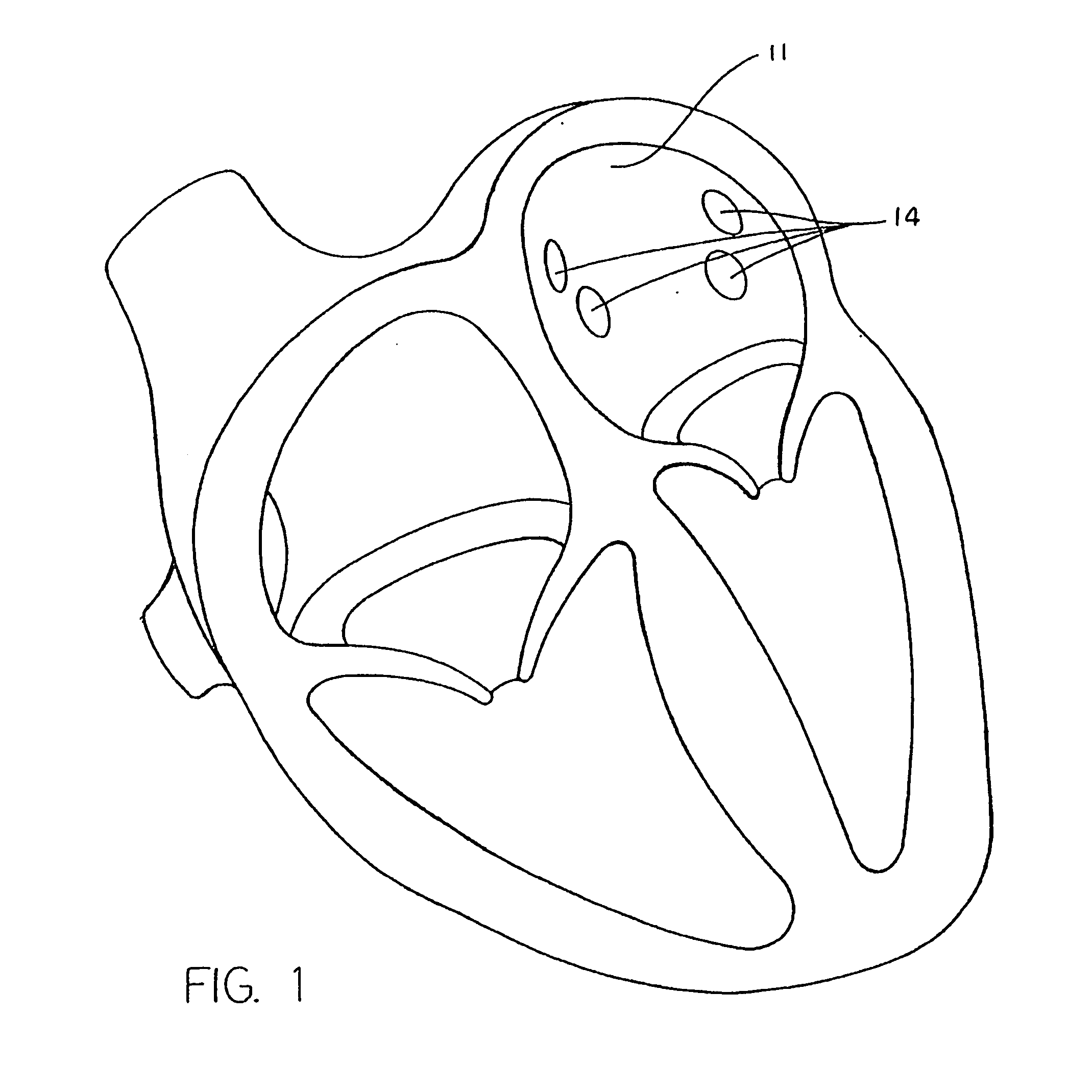 Process and device for the treatment of atrial arrhythmia