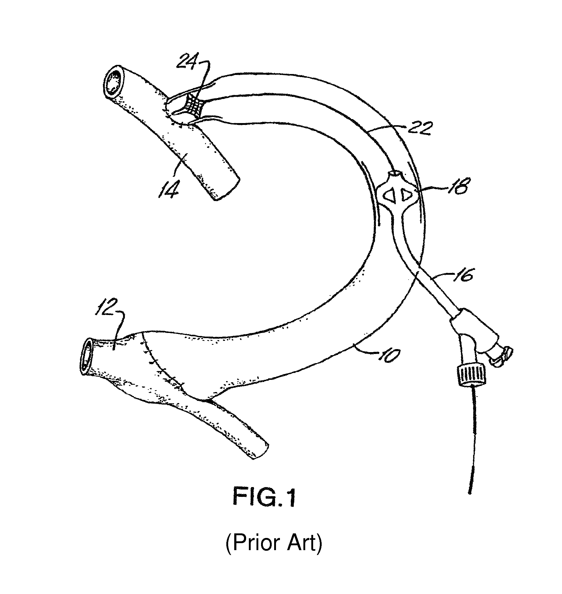 Temporary vascular scaffold and scoring device