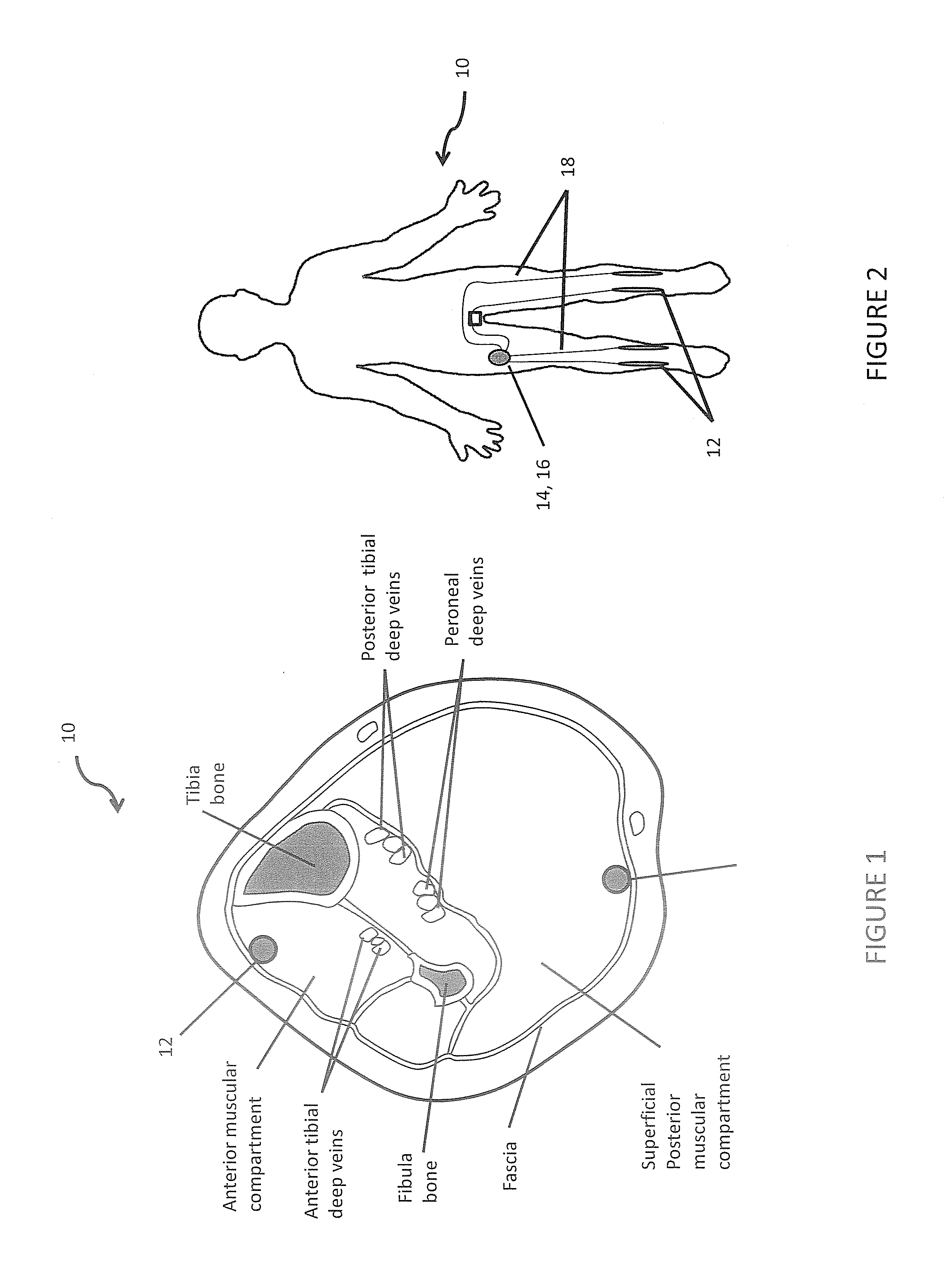 Implantable device for pulsatile compression