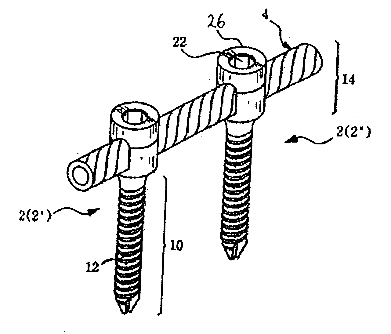 Spinal stabilization device