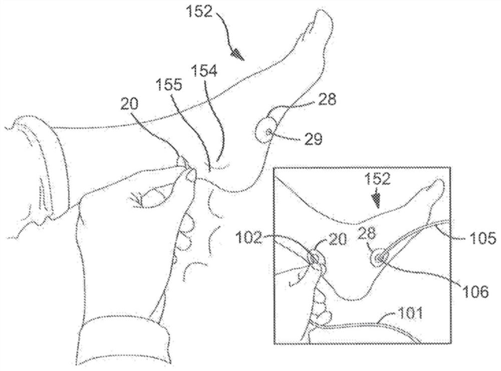 Methods and systems for monitoring and treating conditions via posterior tibial nerve stimulation