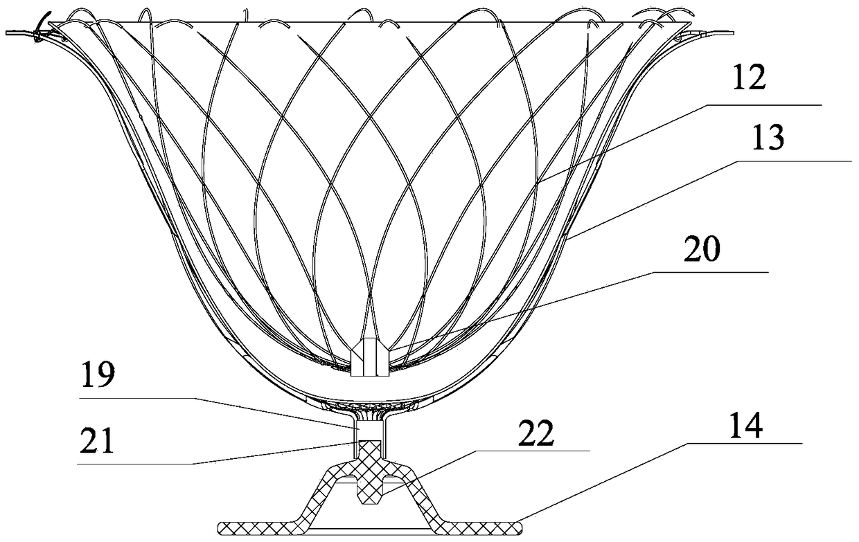 Left Ventricular Volume Reducing Device