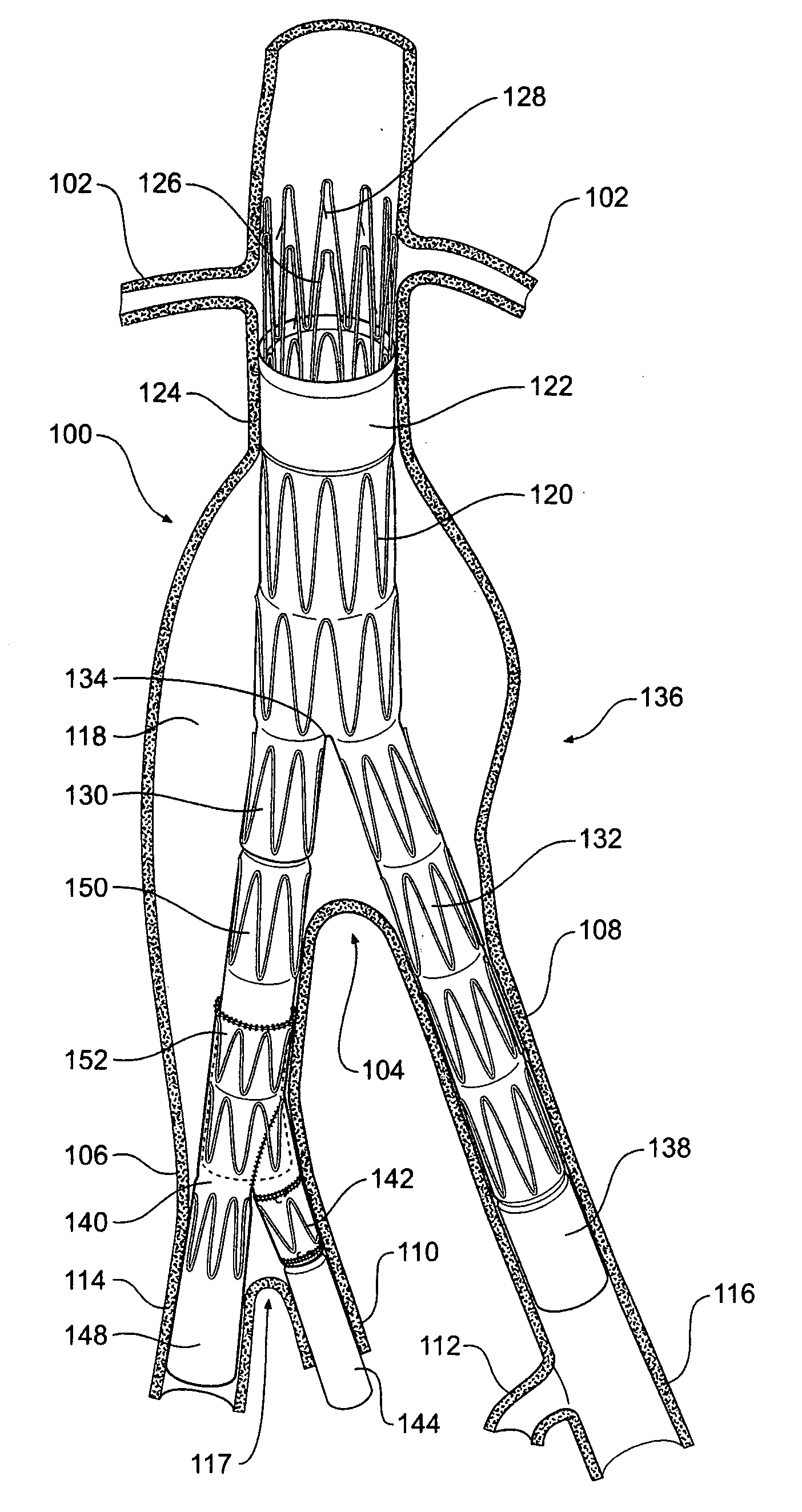 Iliac extension with flared cuff