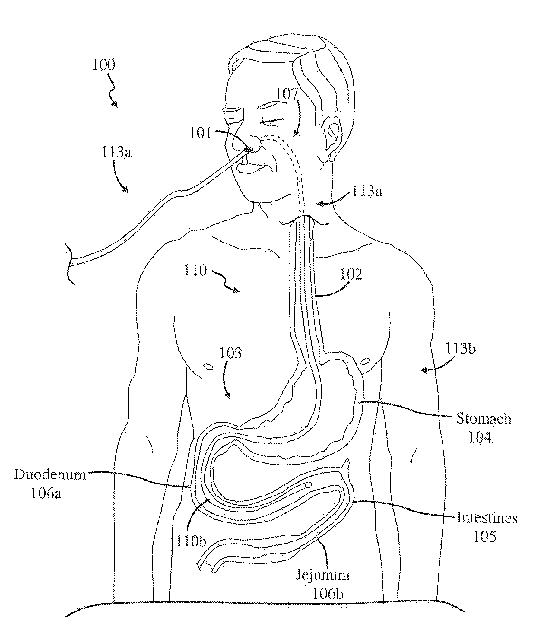 Catheter and method of making the same