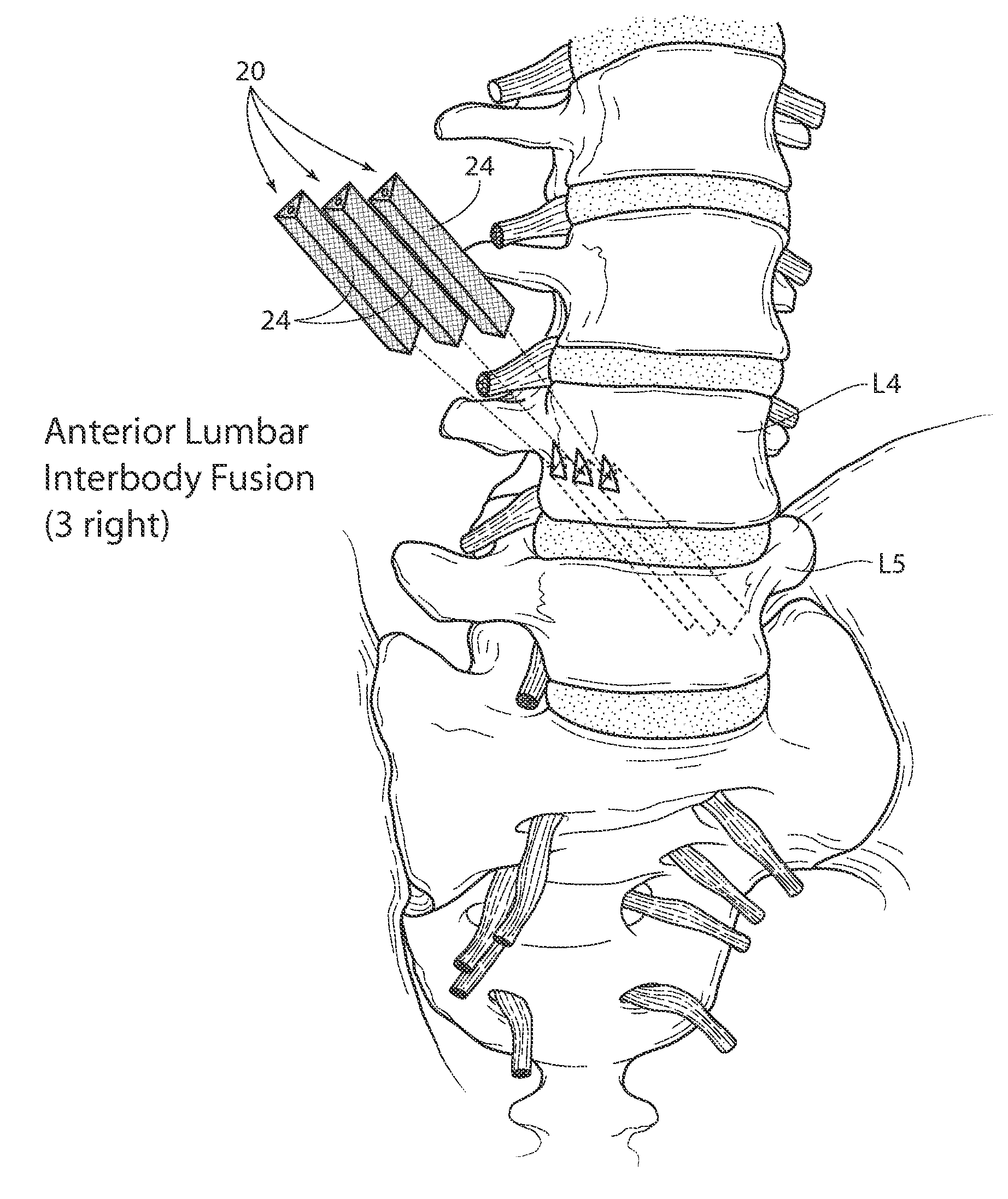 Apparatus, systems, and methods for stablizing a spondylolisthesis