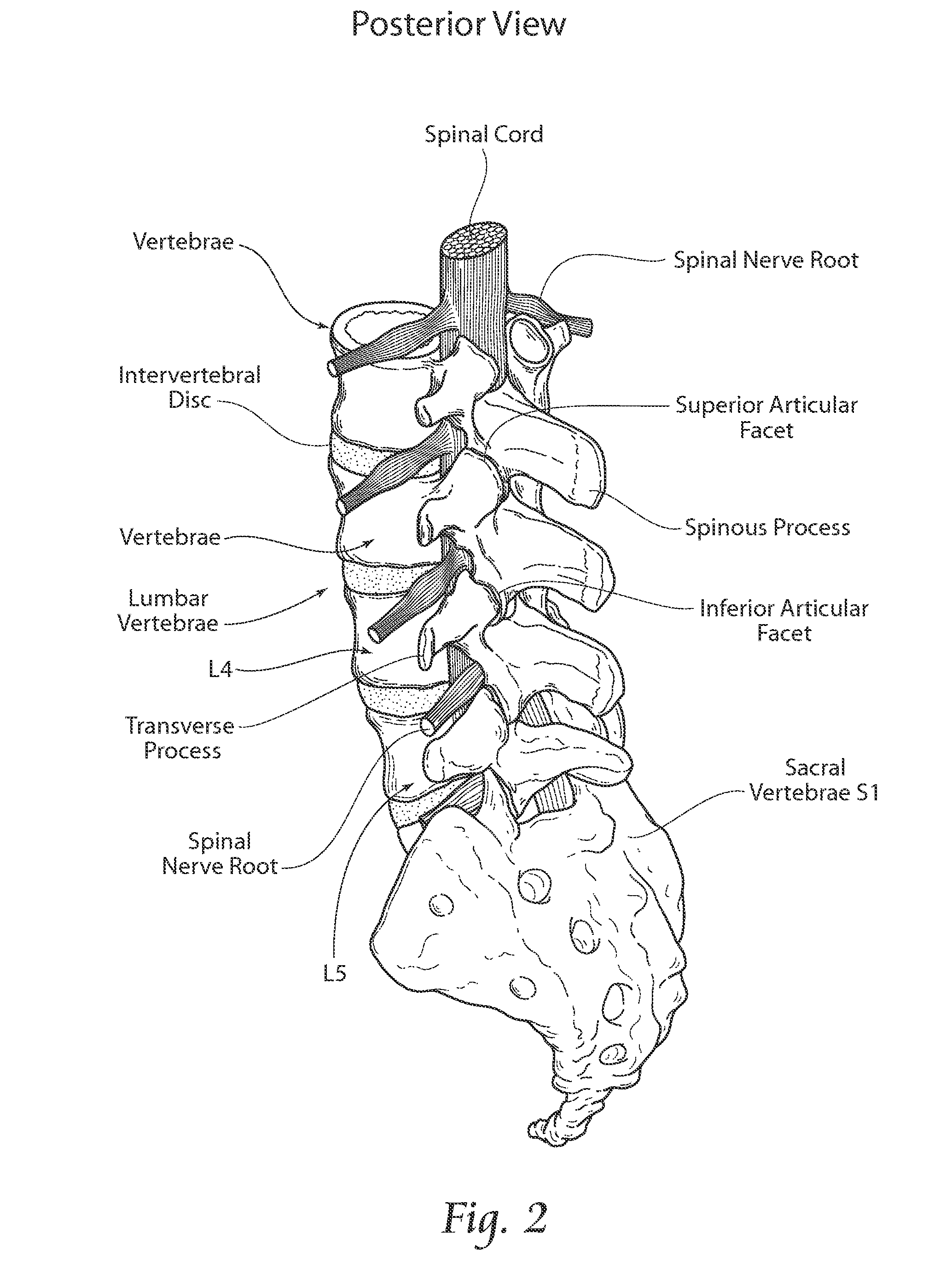 Apparatus, systems, and methods for stablizing a spondylolisthesis