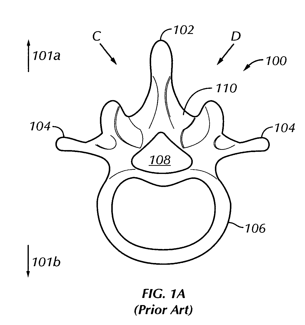 Working channel for minimally invasive spine surgery