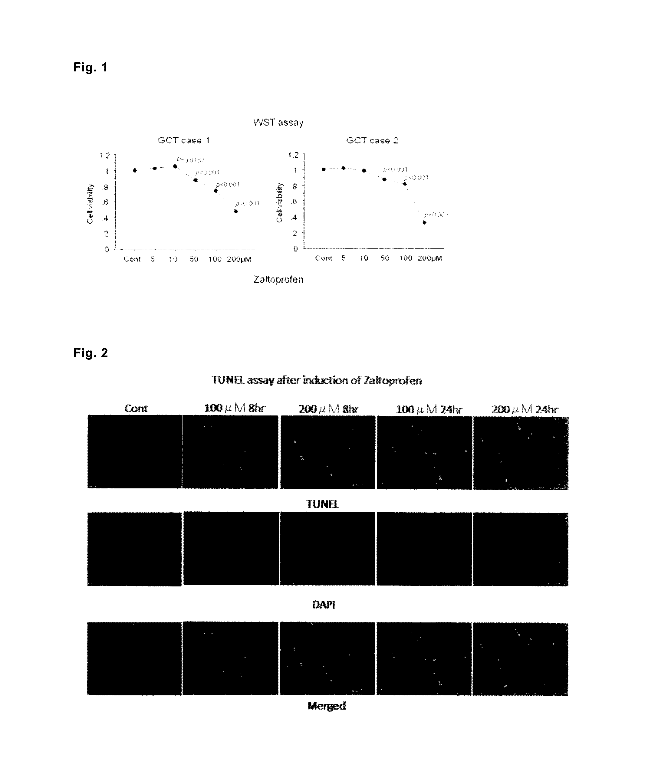 Drug for preventing, treating or preventing metastasis of giant cell tumor that occurs in bone or soft parts, chondrosarcoma, or osteosarcoma, local injection for arterial embolization, and artificial bone