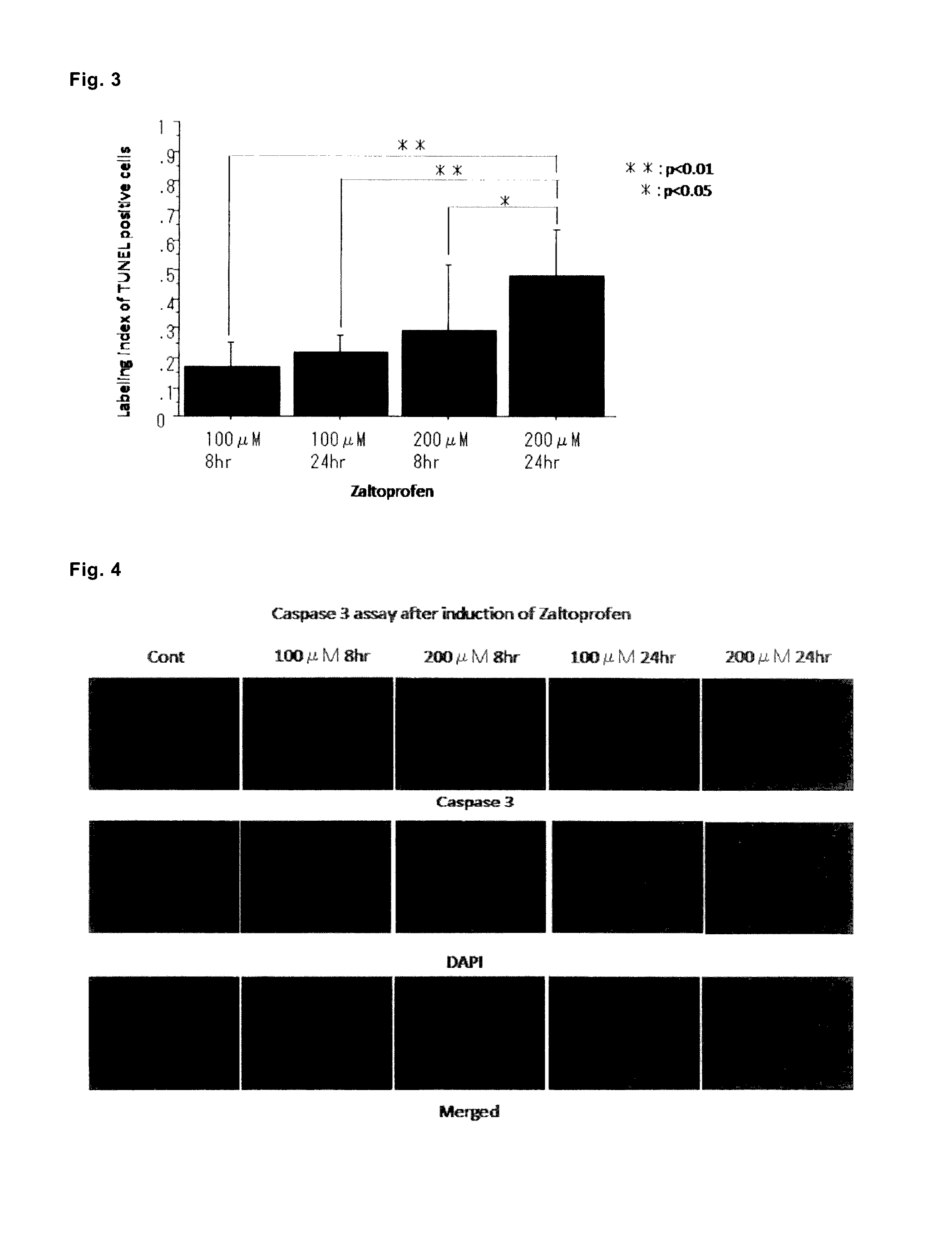 Drug for preventing, treating or preventing metastasis of giant cell tumor that occurs in bone or soft parts, chondrosarcoma, or osteosarcoma, local injection for arterial embolization, and artificial bone