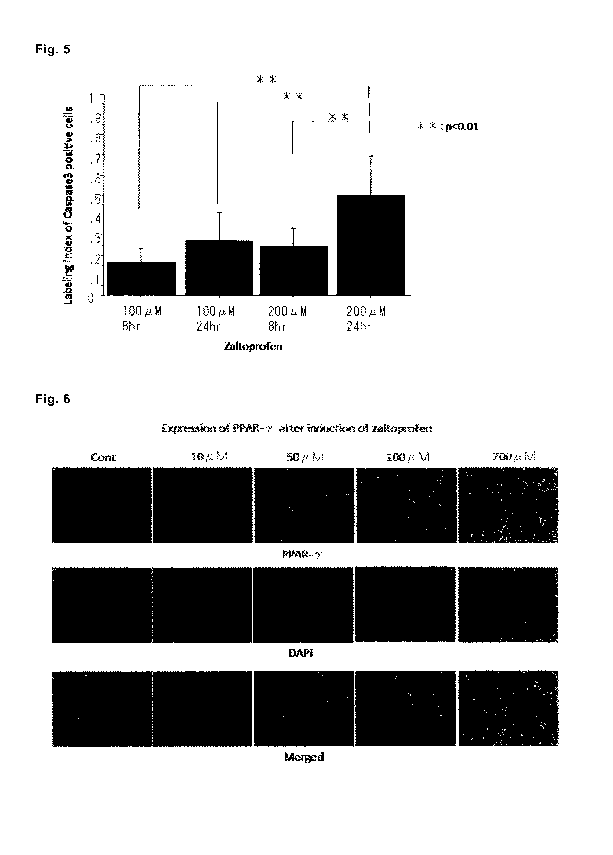 Drug for preventing, treating or preventing metastasis of giant cell tumor that occurs in bone or soft parts, chondrosarcoma, or osteosarcoma, local injection for arterial embolization, and artificial bone