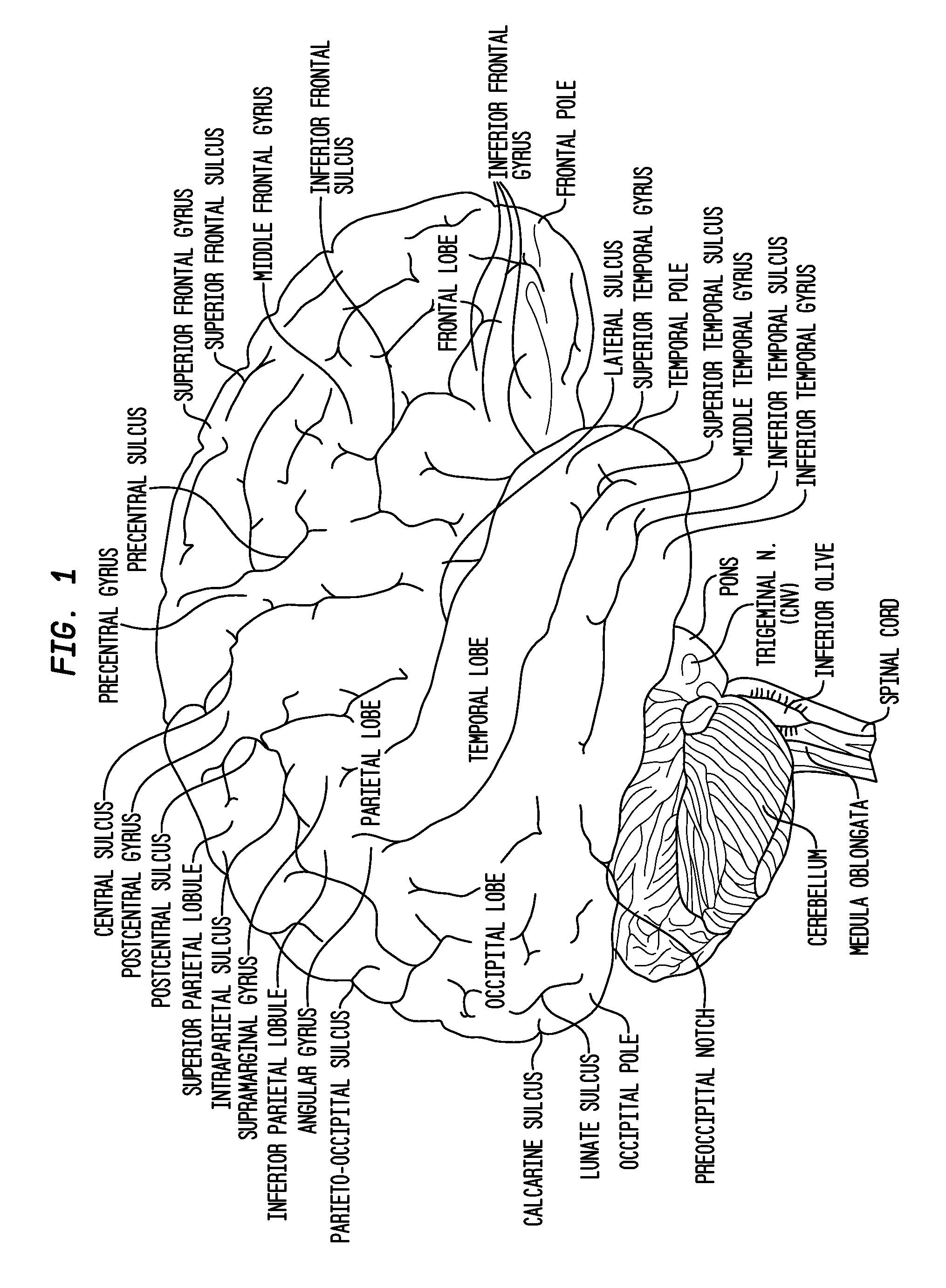 Intraventricular drug delivery system for improving outcome after a brain injury affecting cerebral blood flow