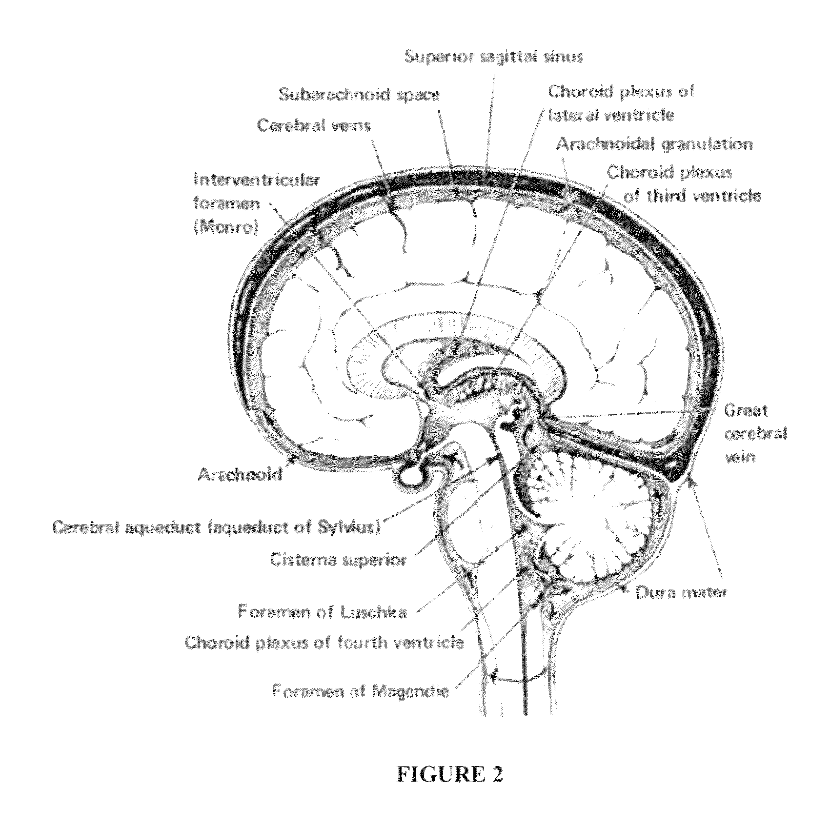 Intraventricular drug delivery system for improving outcome after a brain injury affecting cerebral blood flow