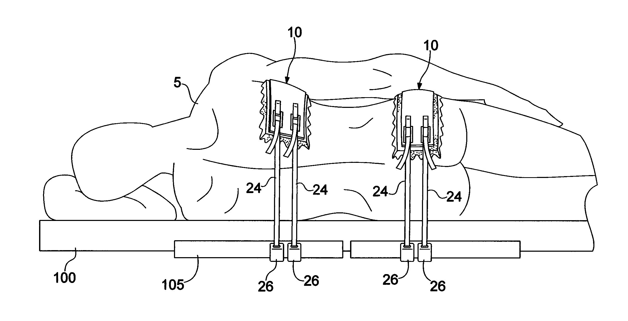 Patient positioning system and method for positioning a patient during a surgical procedure