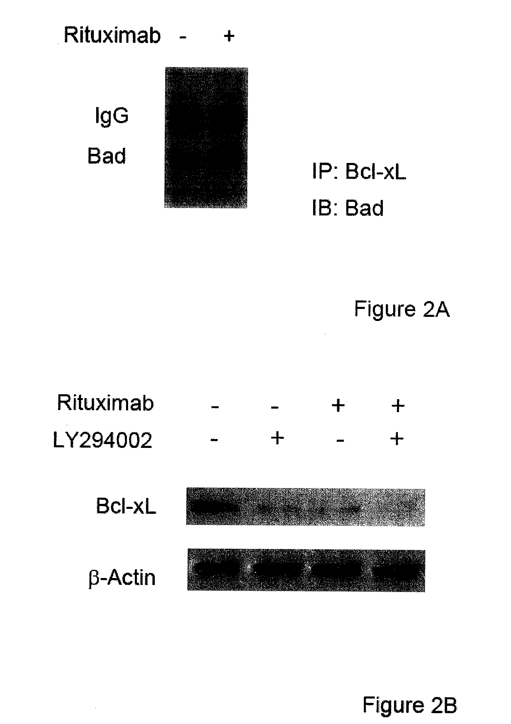 Molecular signaling pathways triggered by rituximab: prognostic, diagnostic, and therapeutic uses