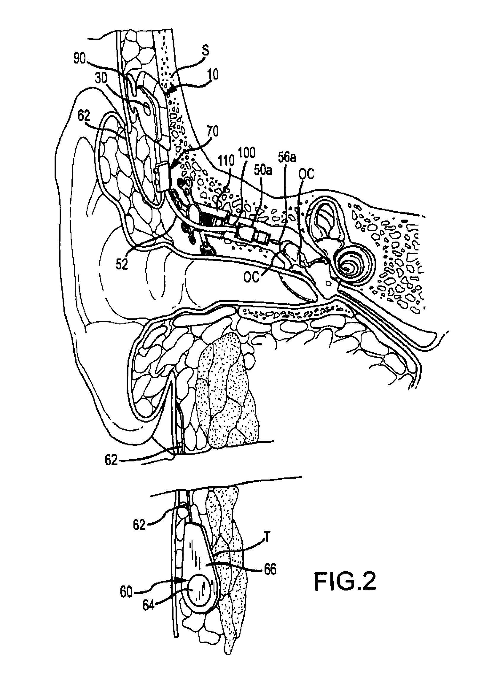 Implantable auditory stimulation system and method with offset implanted microphones