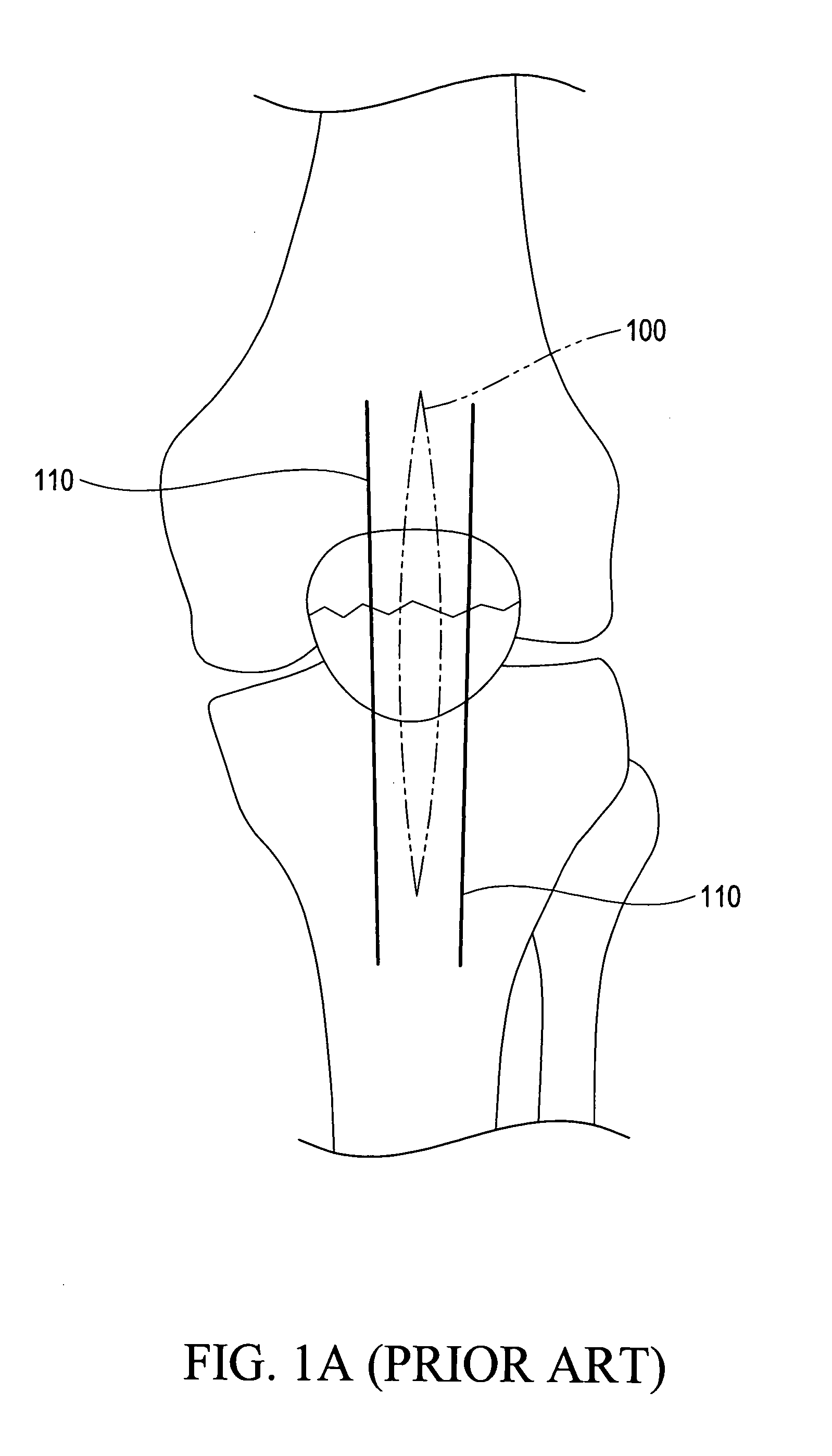 Minimally invasive skeletal fixation device