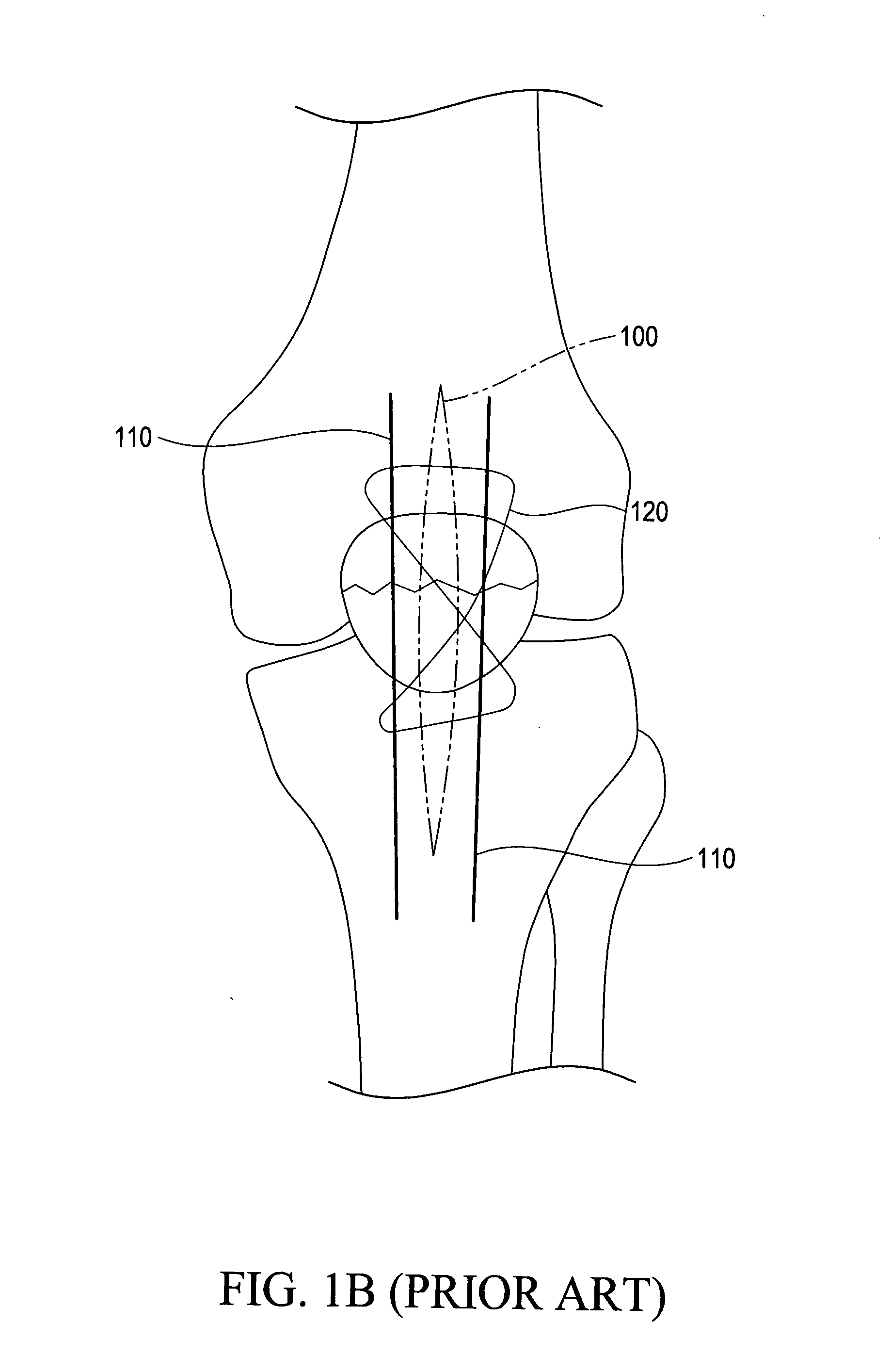 Minimally invasive skeletal fixation device