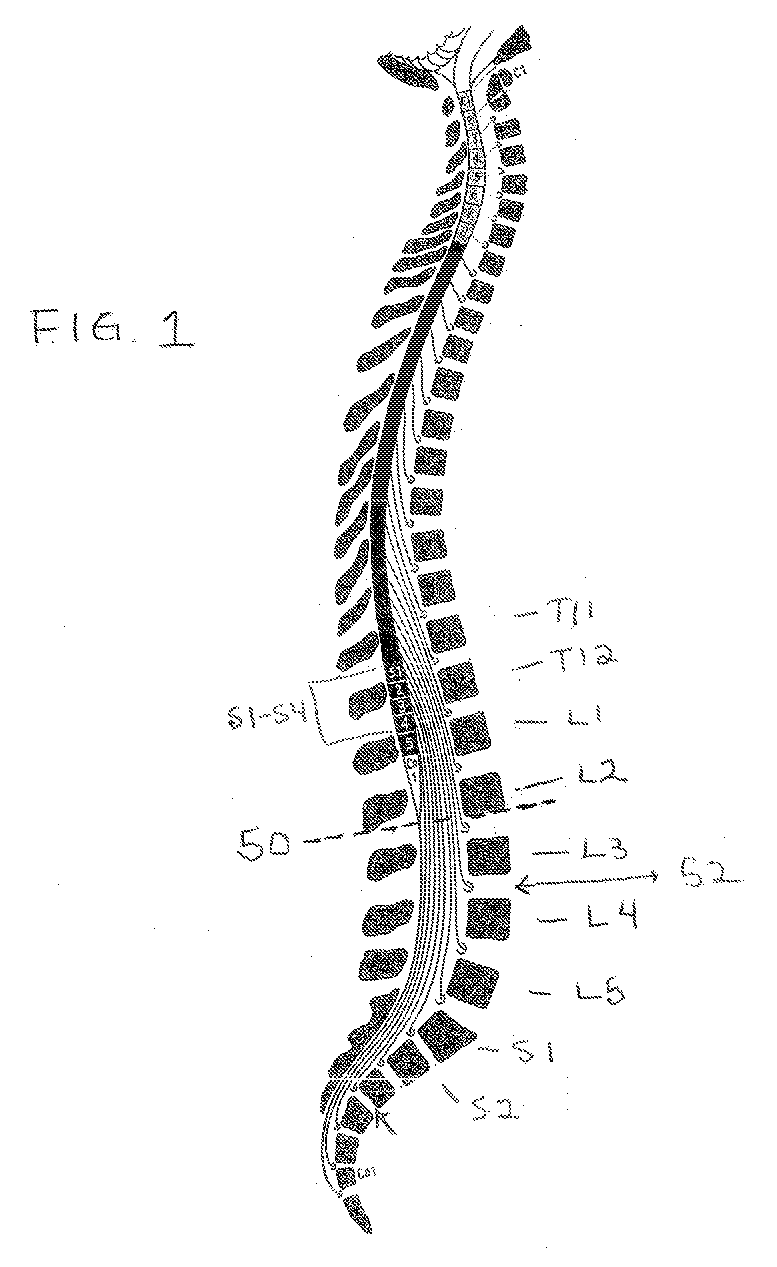 Drug Delivery Methods and Devices for Treating Stress Urinary Incontinence