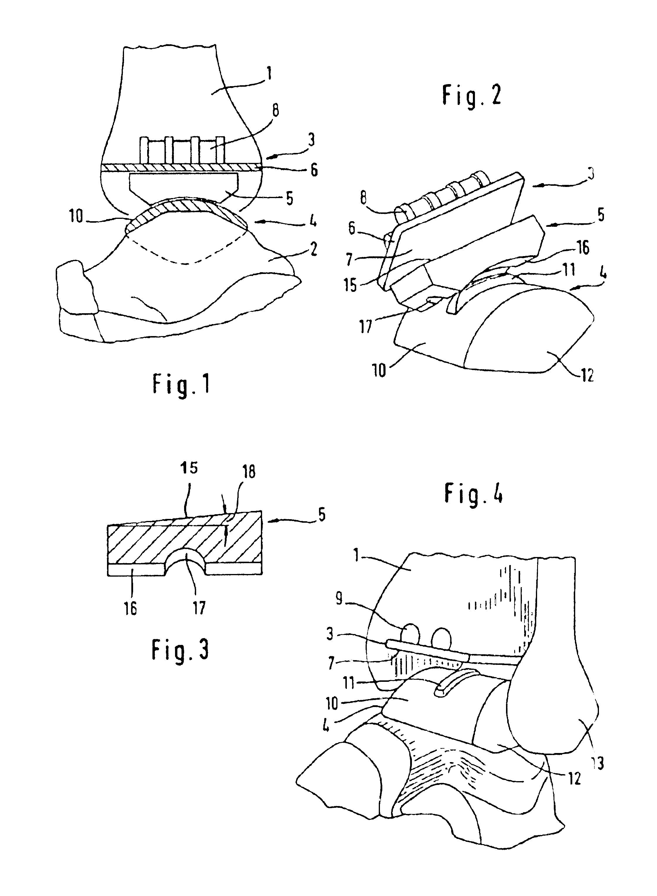 Ankle-joint endoprosthesis