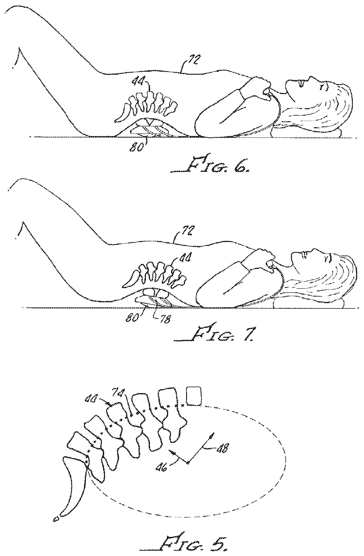 Joint separator for body alignment