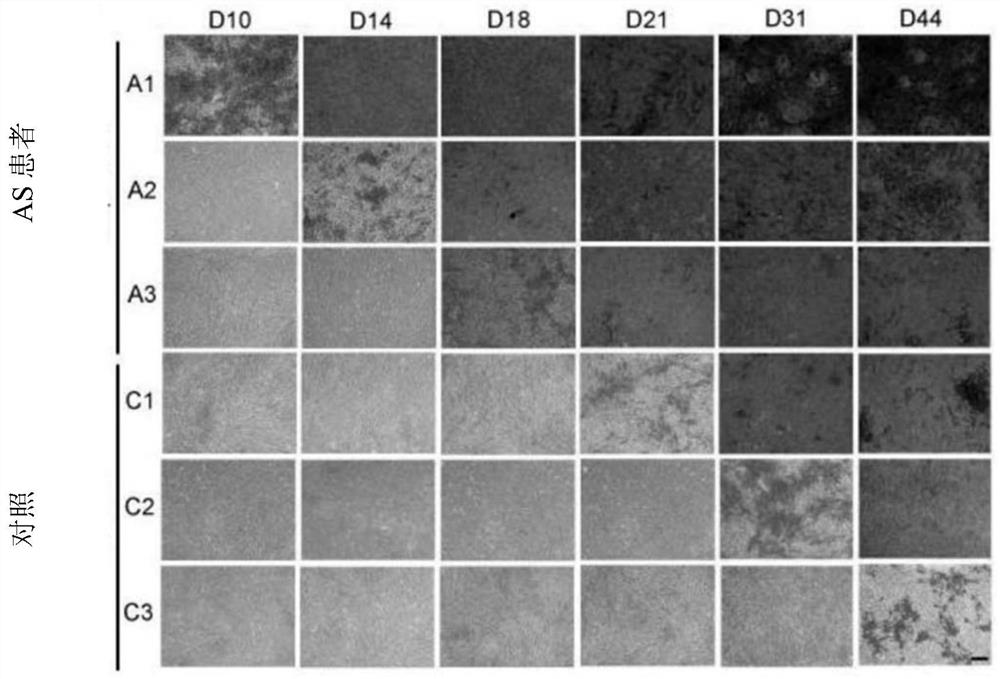 A biomarker and target for diagnosis, prognosis and treatment of ankylosing spondylitis