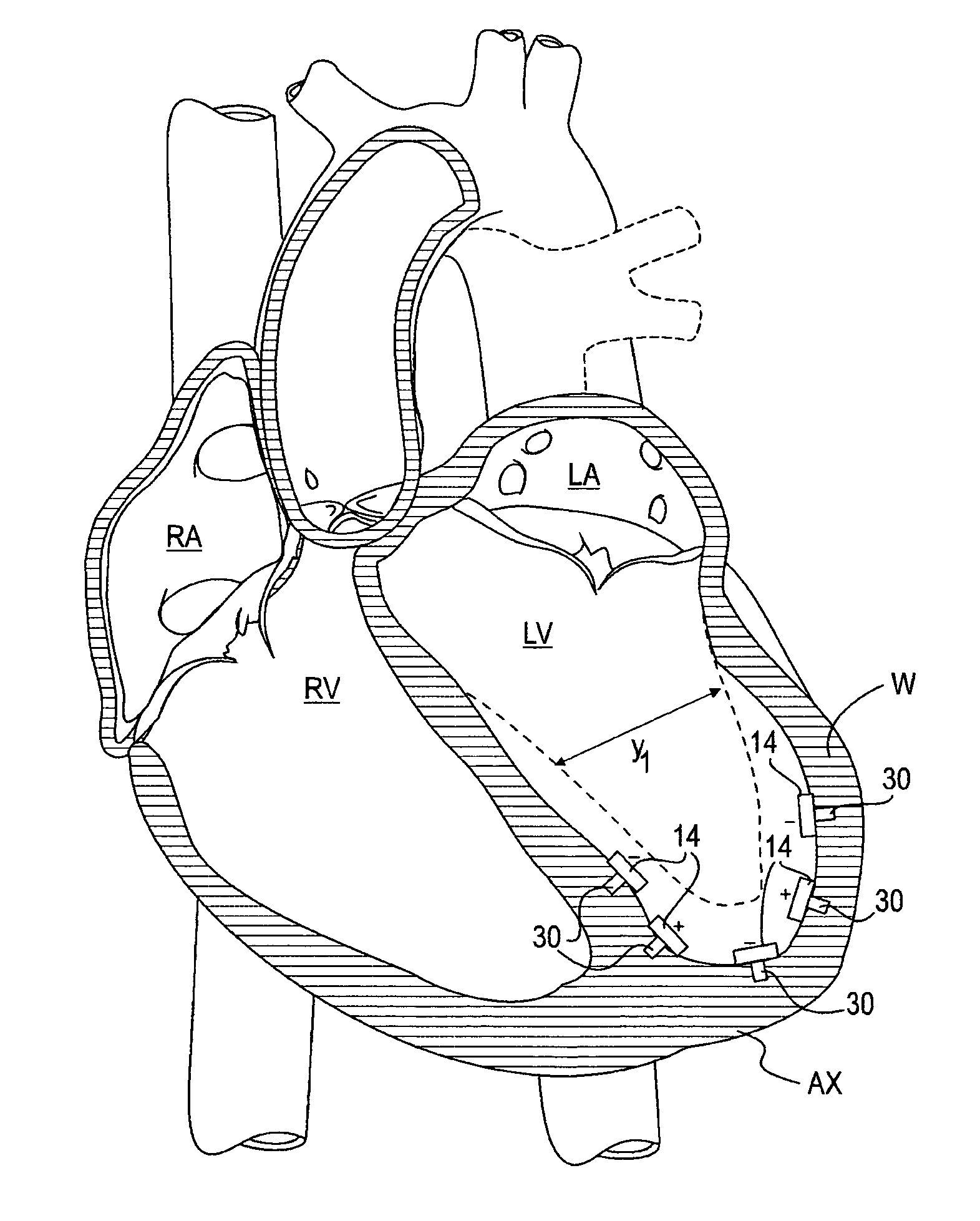 Magnetic devices and methods for reshaping heart anatomy