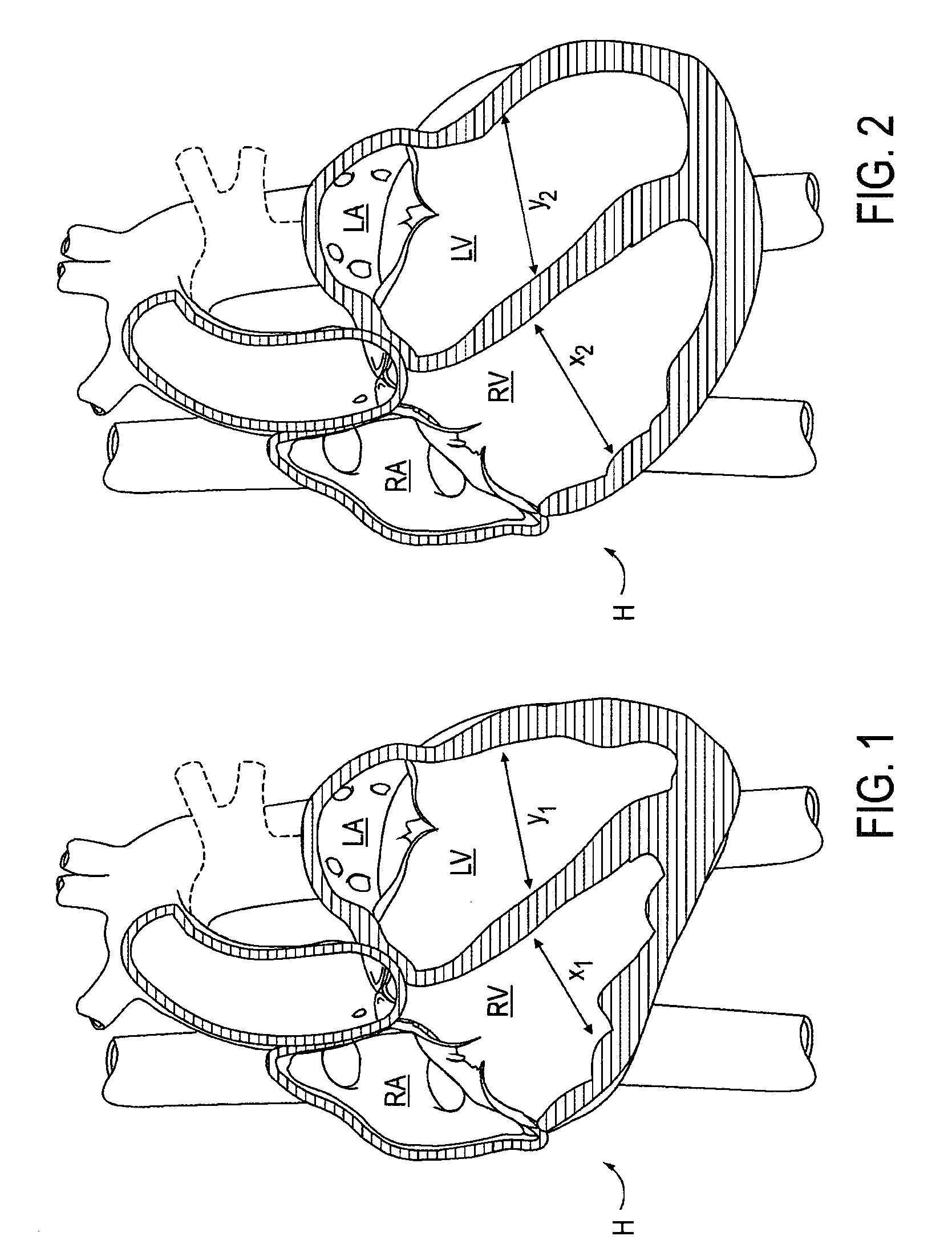 Magnetic devices and methods for reshaping heart anatomy
