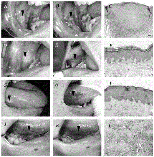 Kit for benign lesion identification and malignant lesion detection of oral mucosa and detection method thereof