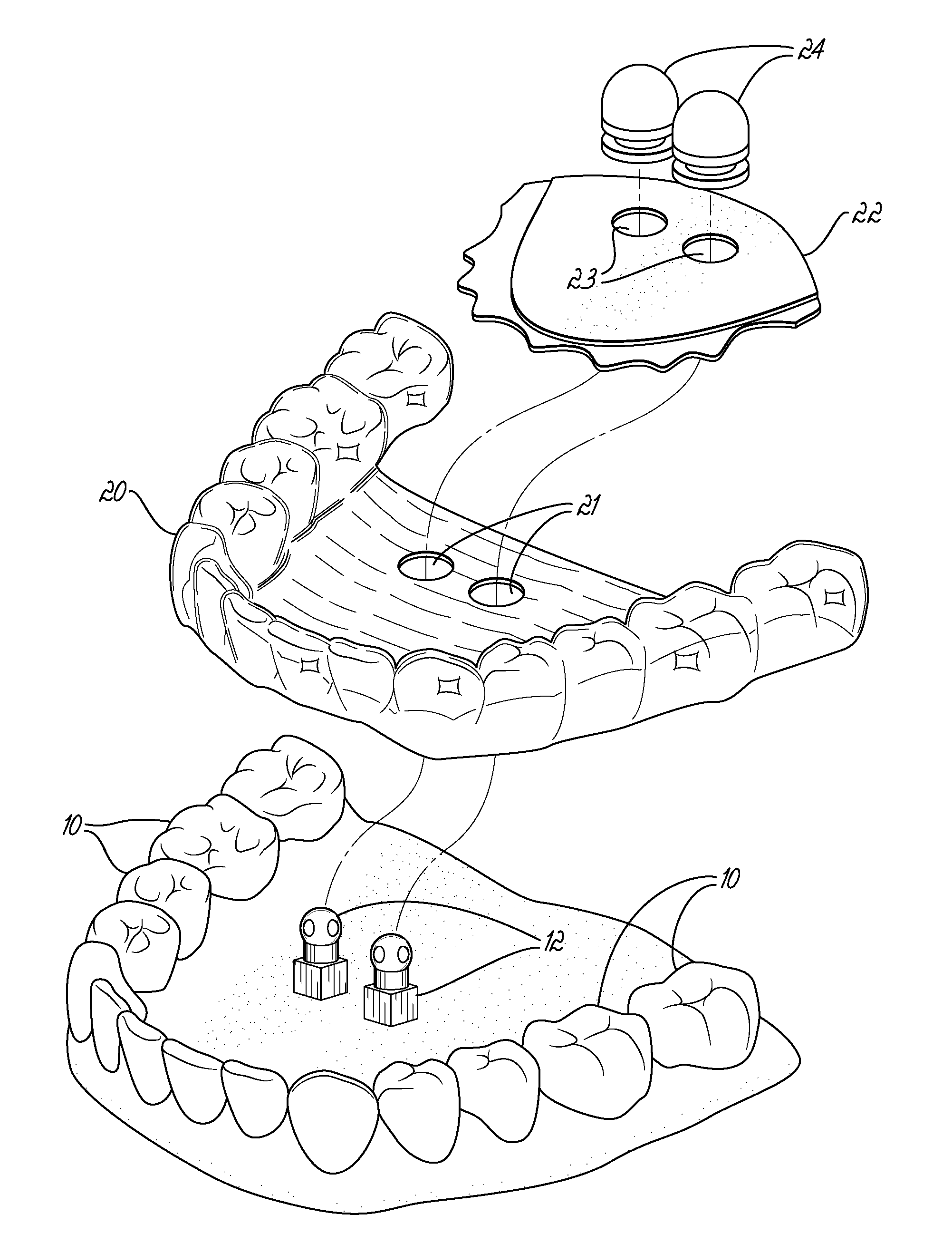 Fabricating custom extensions to thermoformed aligners