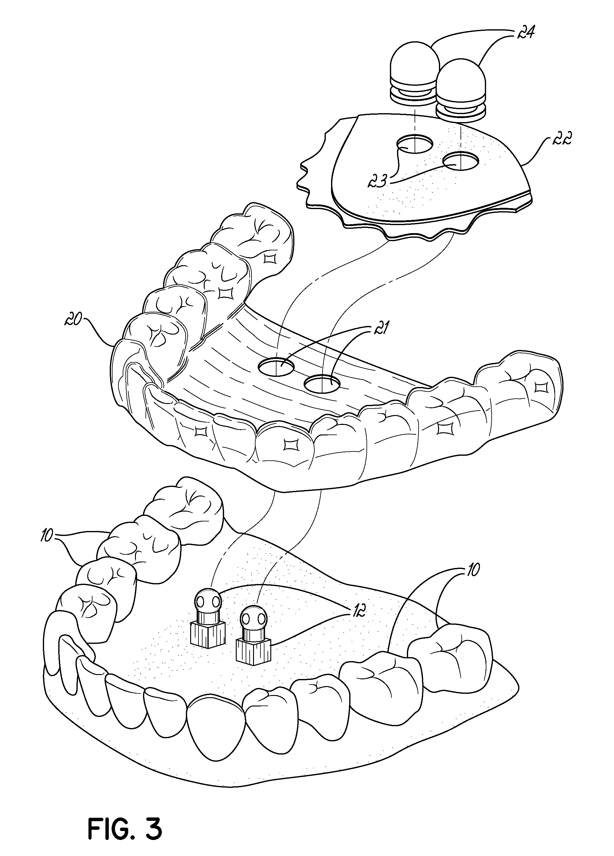 Fabricating custom extensions to thermoformed aligners