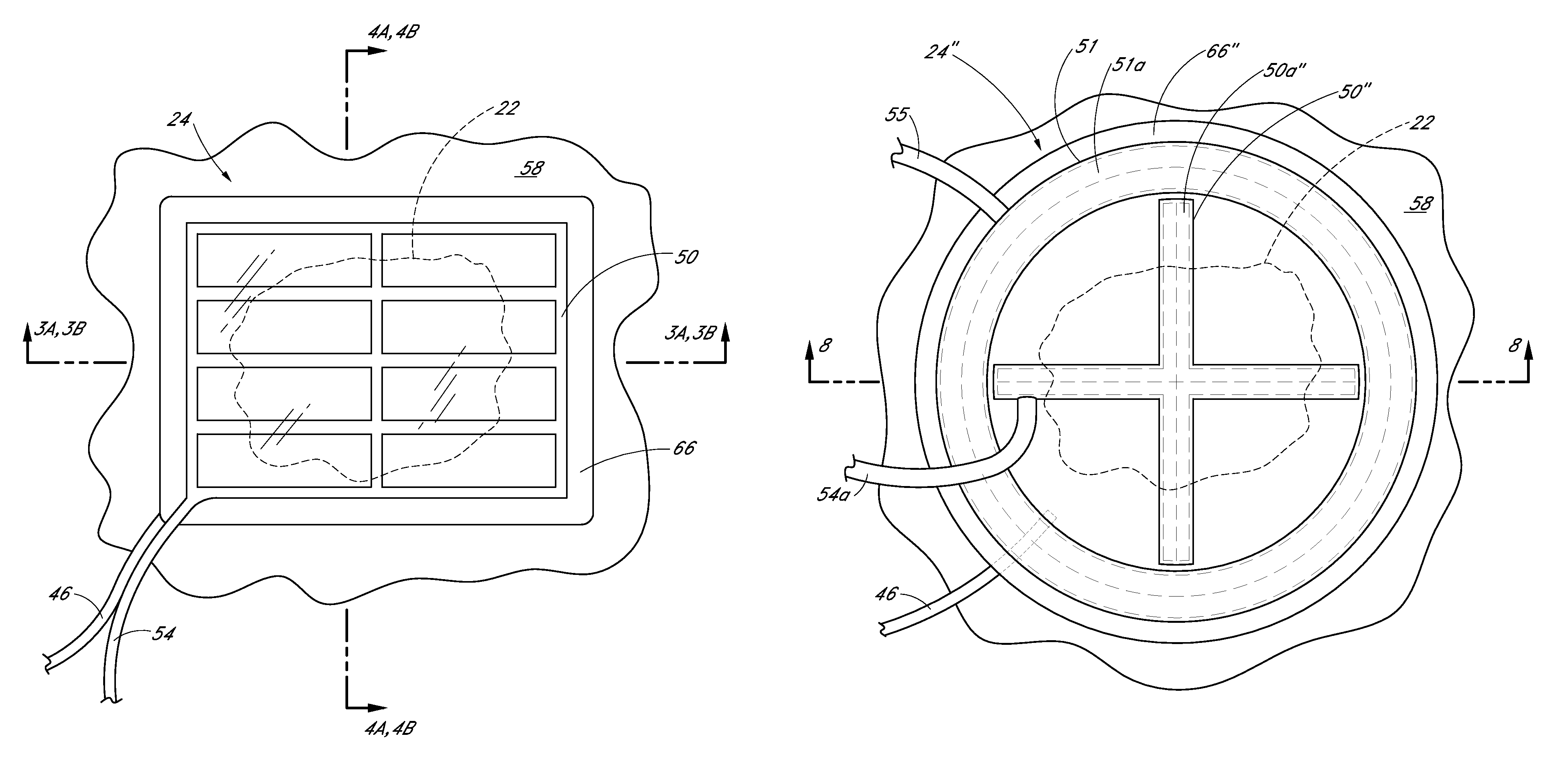 Negative pressure dressing and method of using same