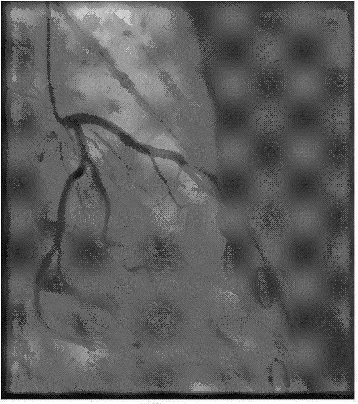 Single-arm x-ray angiography image multiple motion parameter decomposition and estimation method