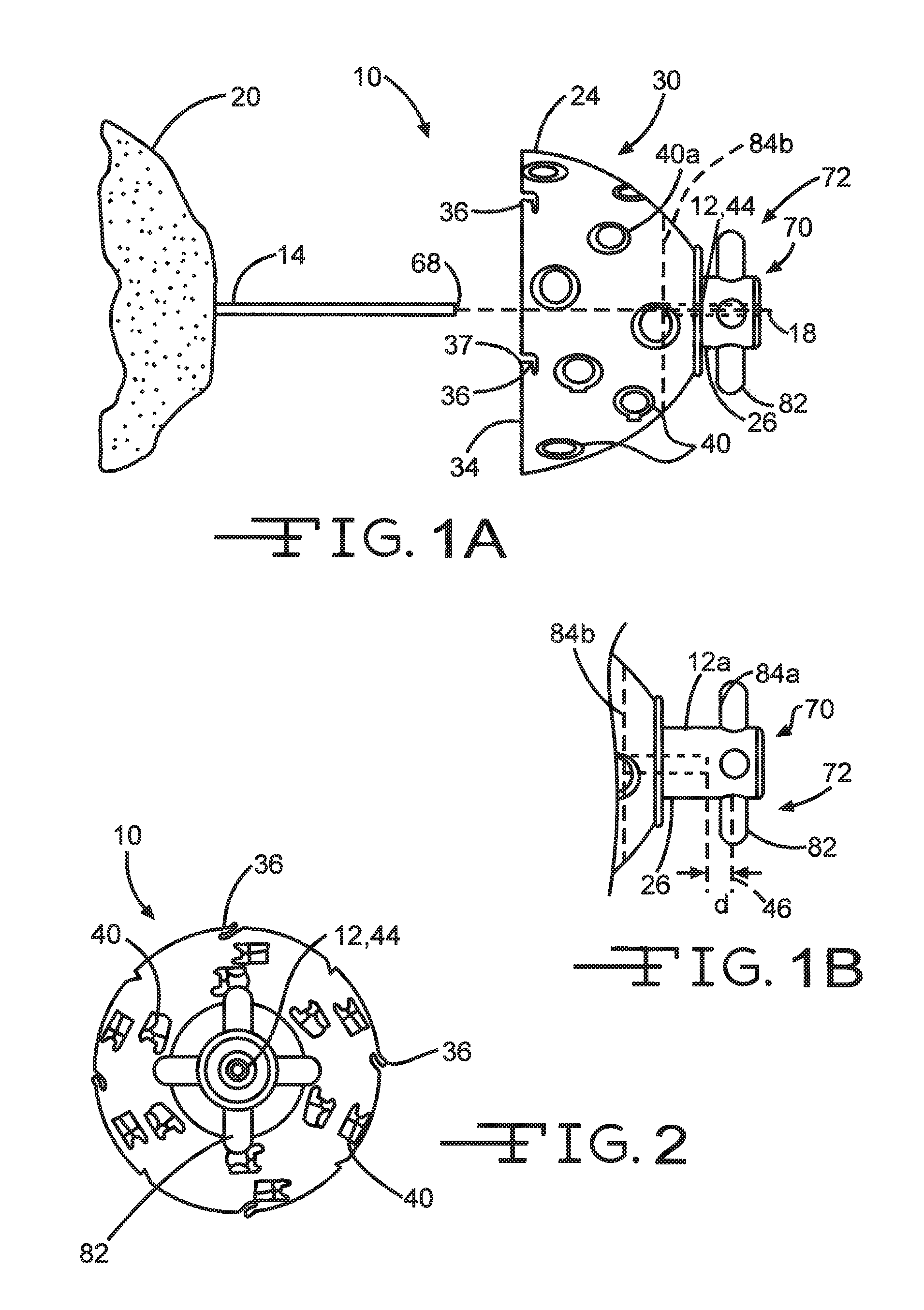 Guided reamer system for reshaping bone