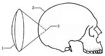 Extracranial standing wave suppression method for high-intensity ultrasound transcranial focusing