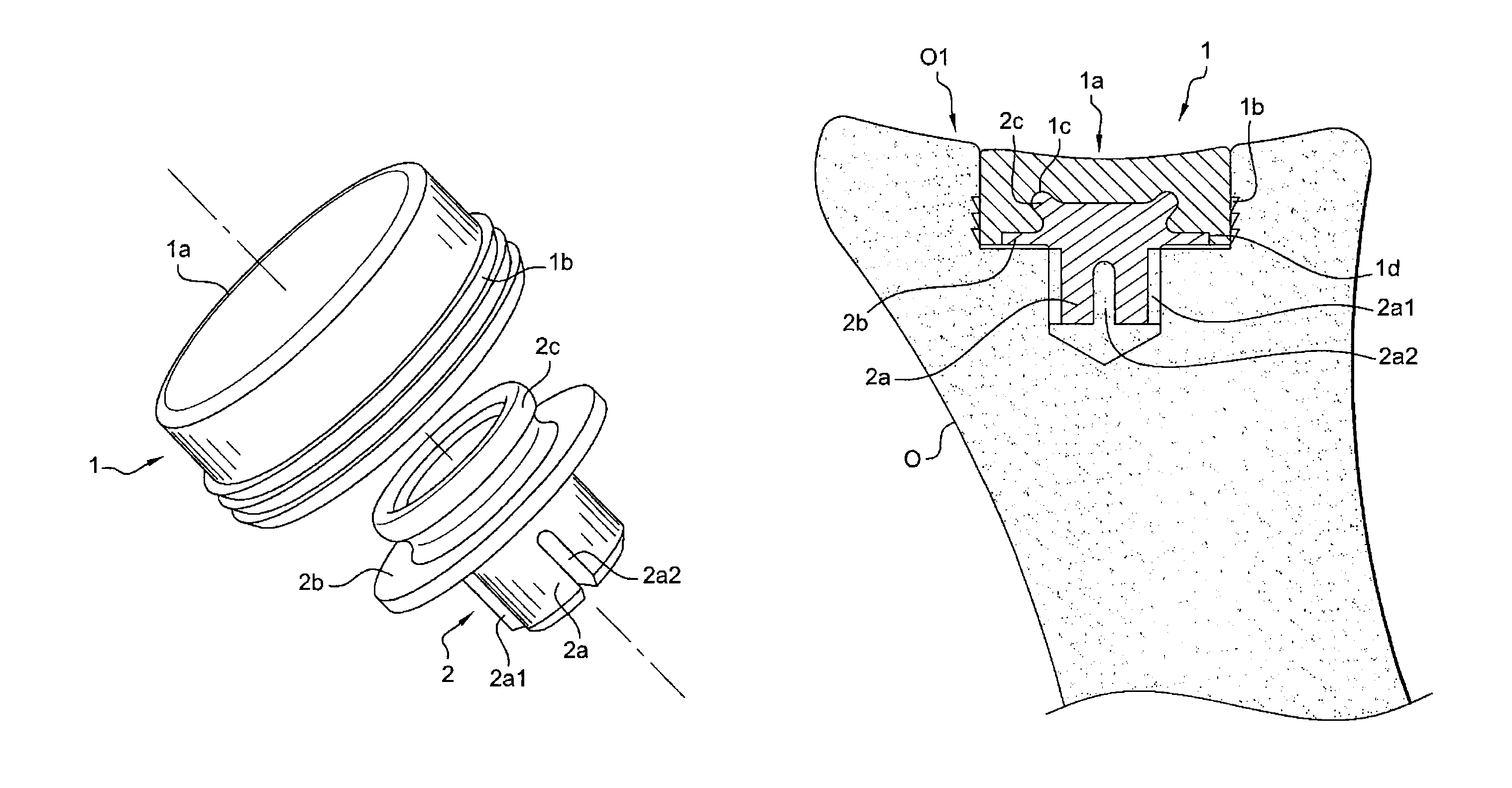 Glenoid implant