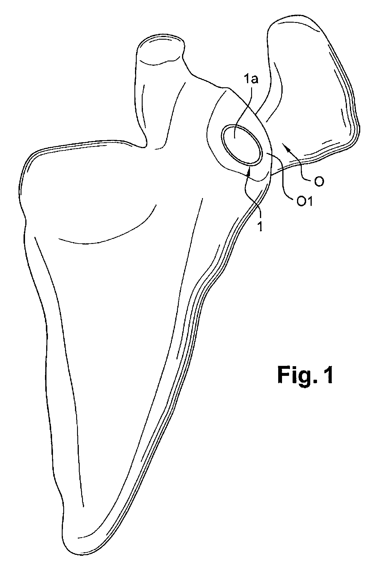 Glenoid implant