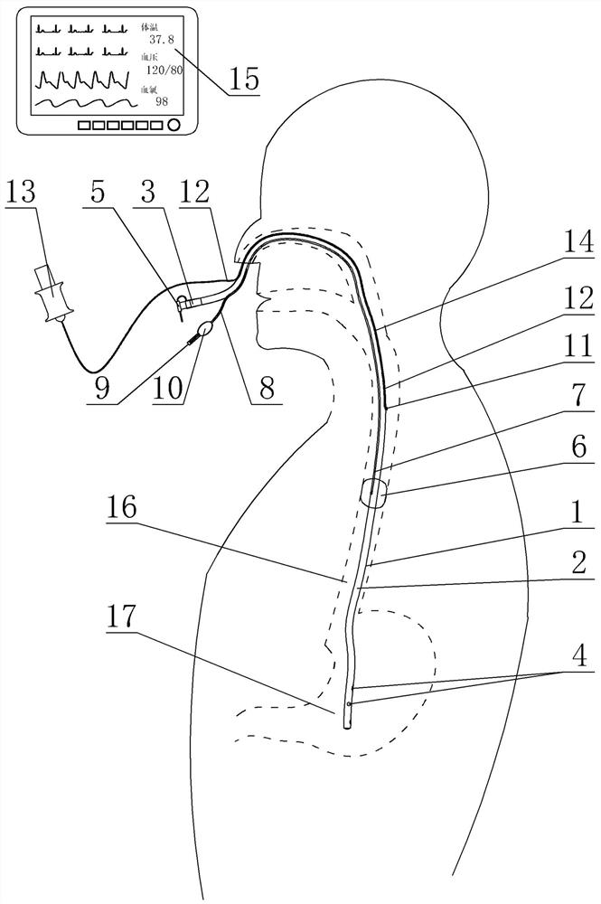 Stomach tube with core temperature detecting and esophageal reflux preventing actions