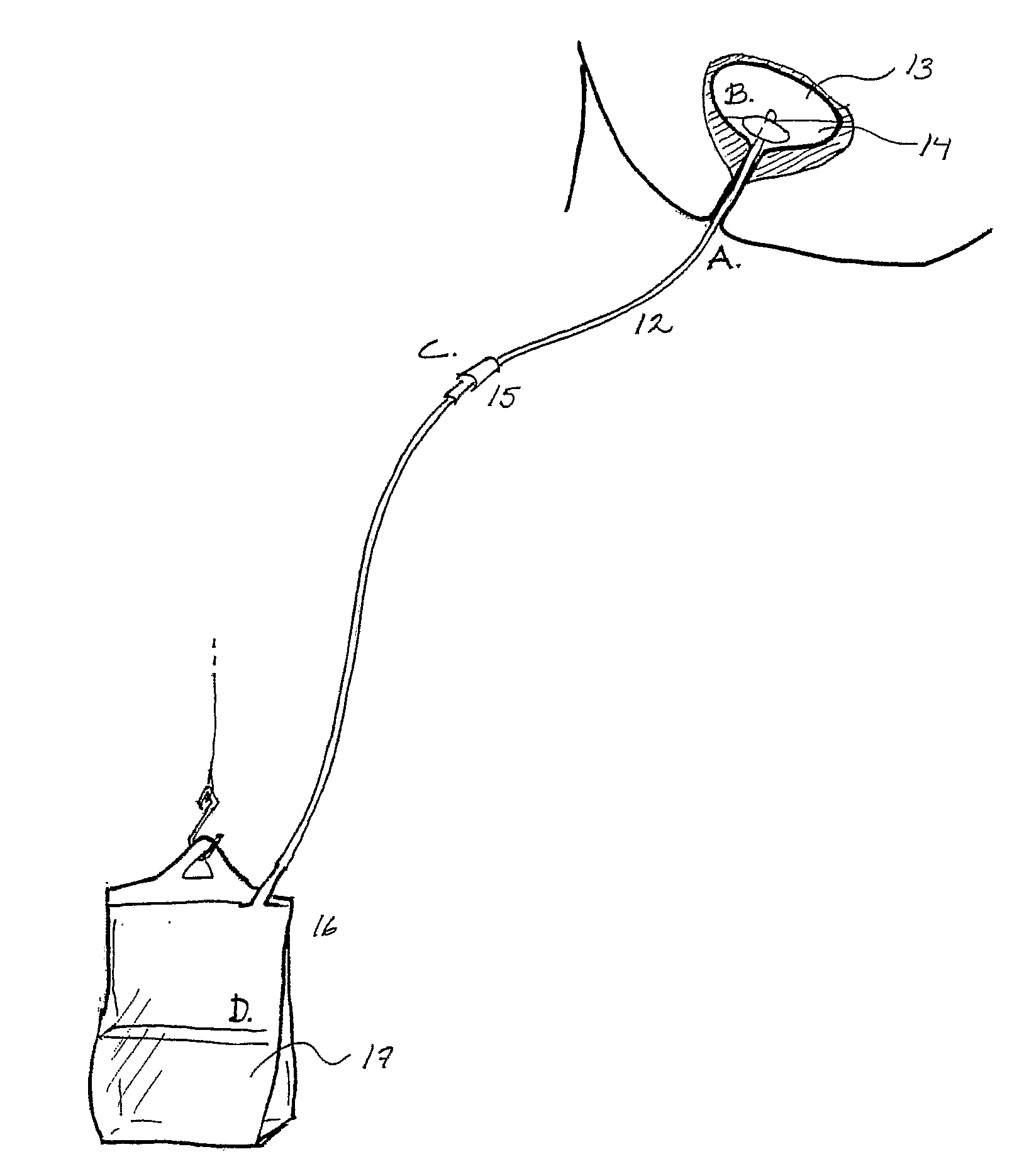 Device and Method for Administering Therapeutic Agents