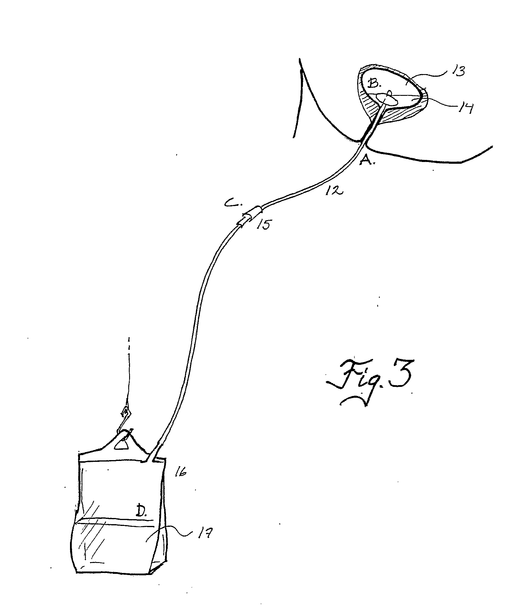 Device and Method for Administering Therapeutic Agents