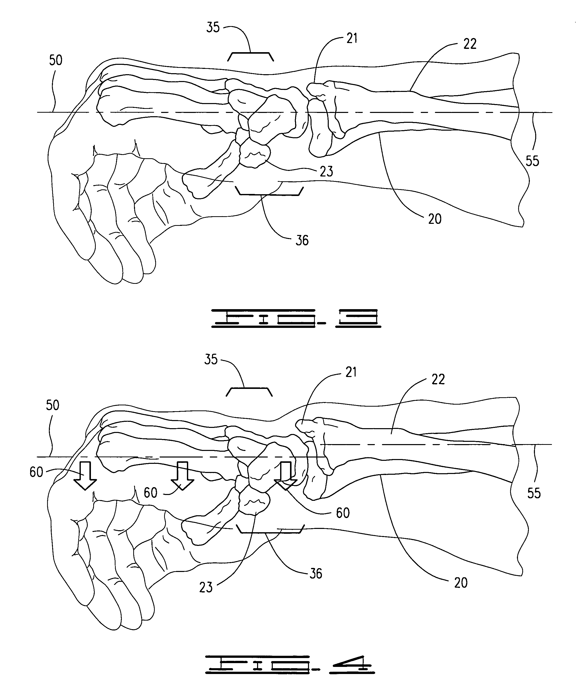 Co-dynamic adjustable orthotic appliance for carpal tunnel syndrome